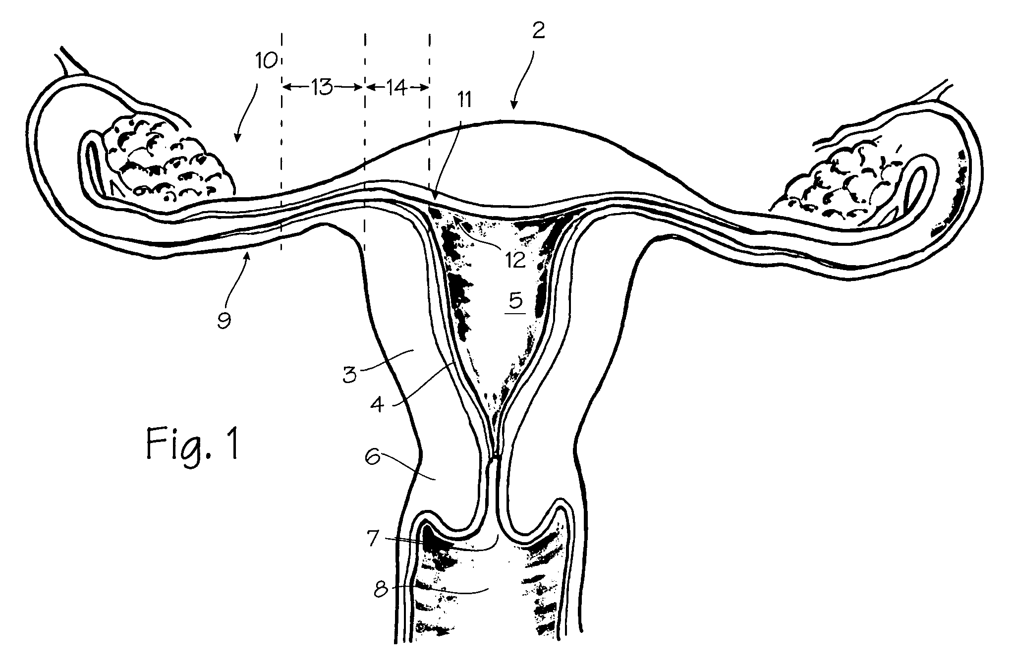 Method and apparatus for tubal occlusion