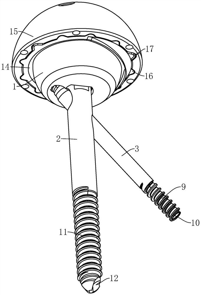 Bionic hip joint prosthesis with reserved femoral neck