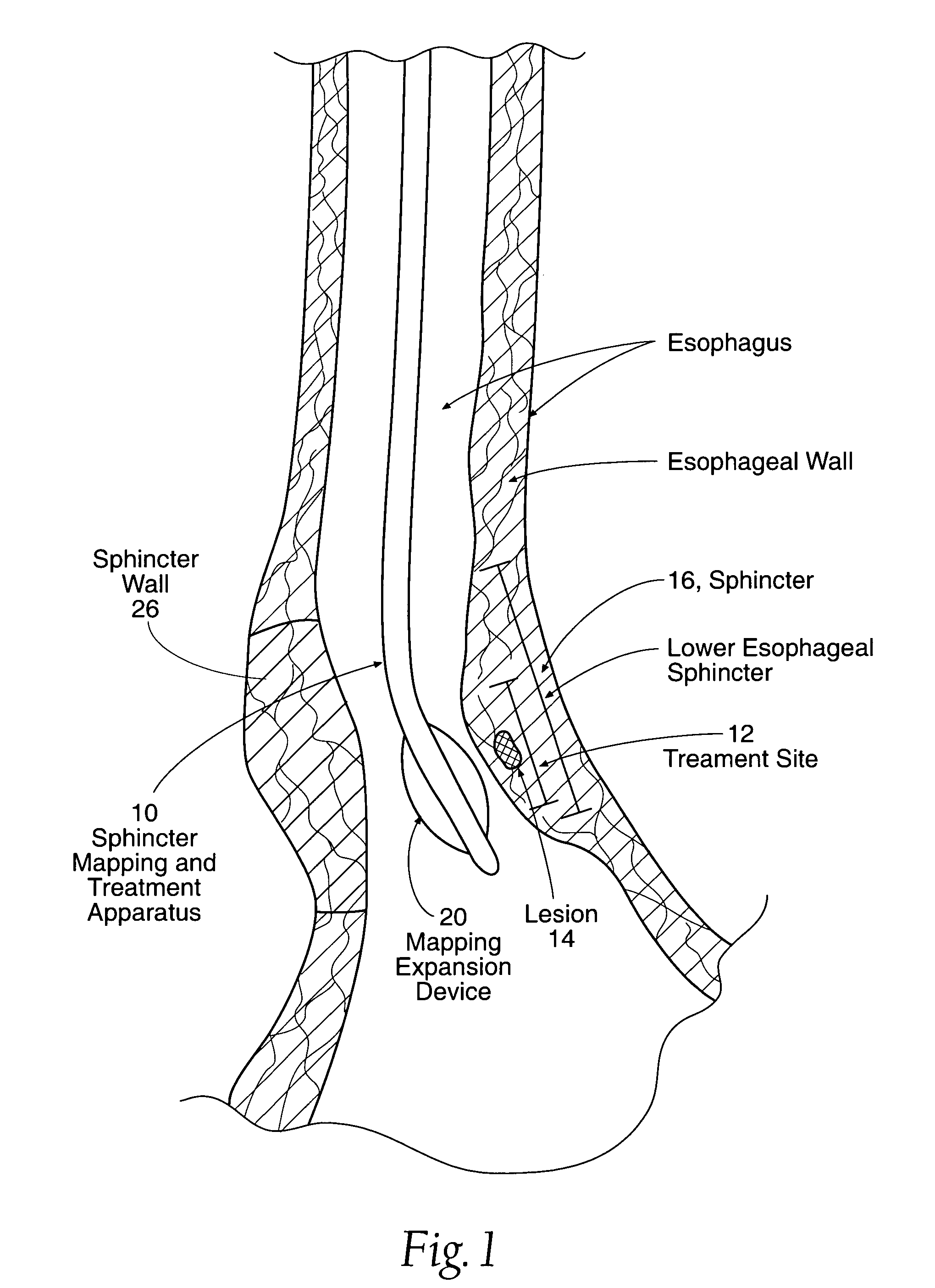 Apparatus to detect and treat aberrant myoelectric activity