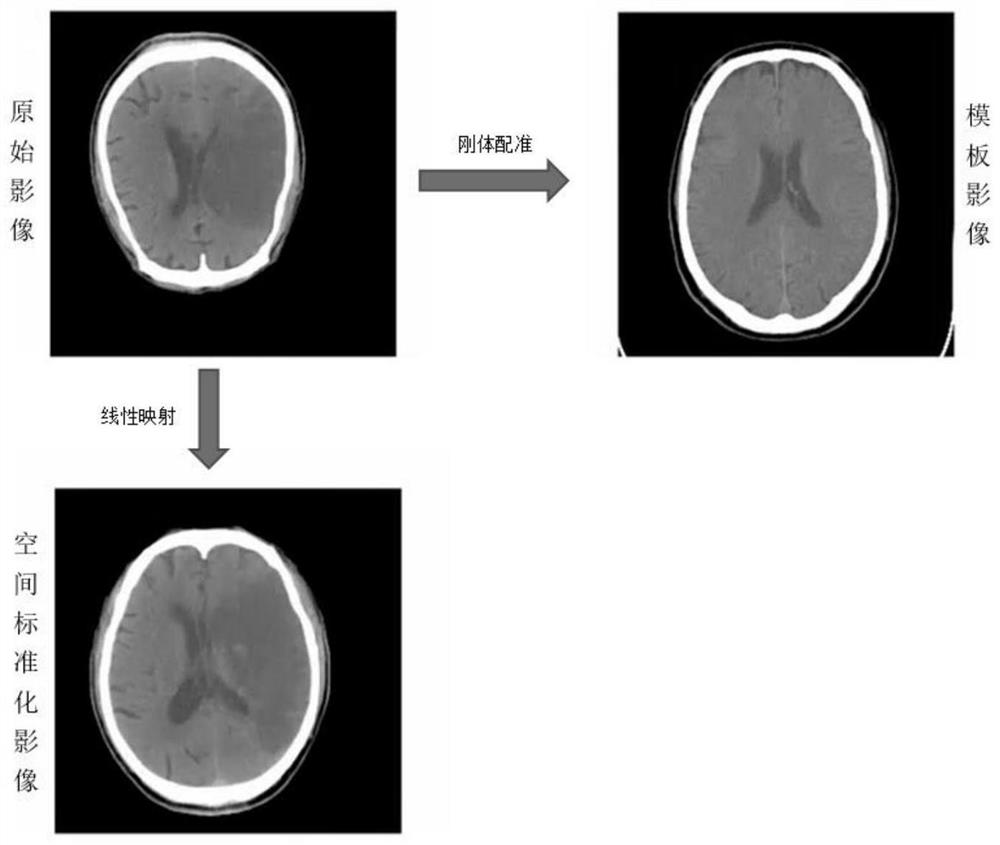 Acute ischemic stroke focus automatic segmentation method and system, terminal and medium