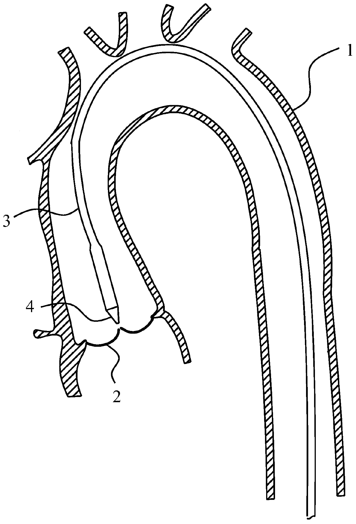 Bending-adjustable sheathed catheter and delivery system employing same