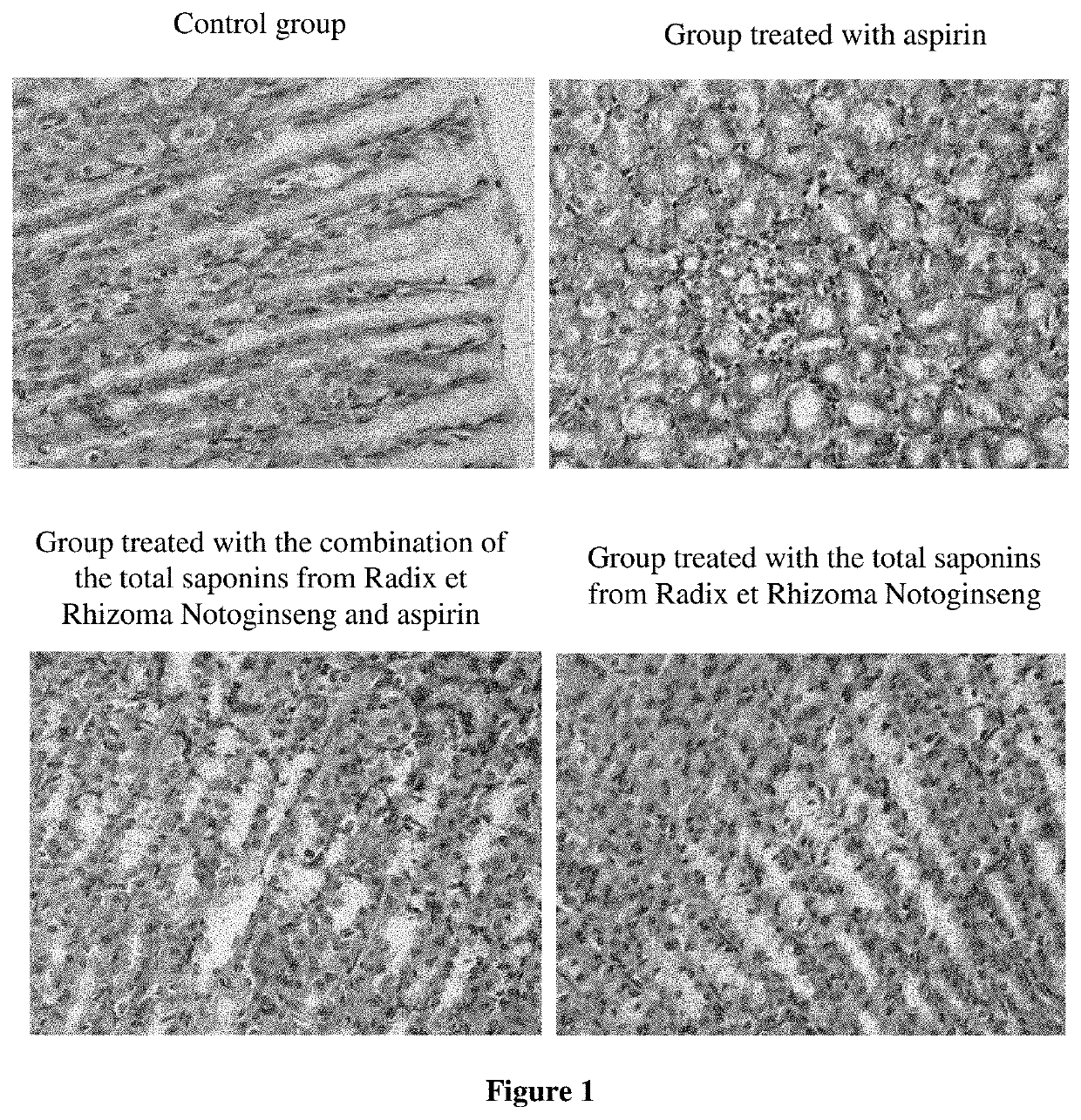 Novel use of combination or composition of panax notoginseng and aspirin