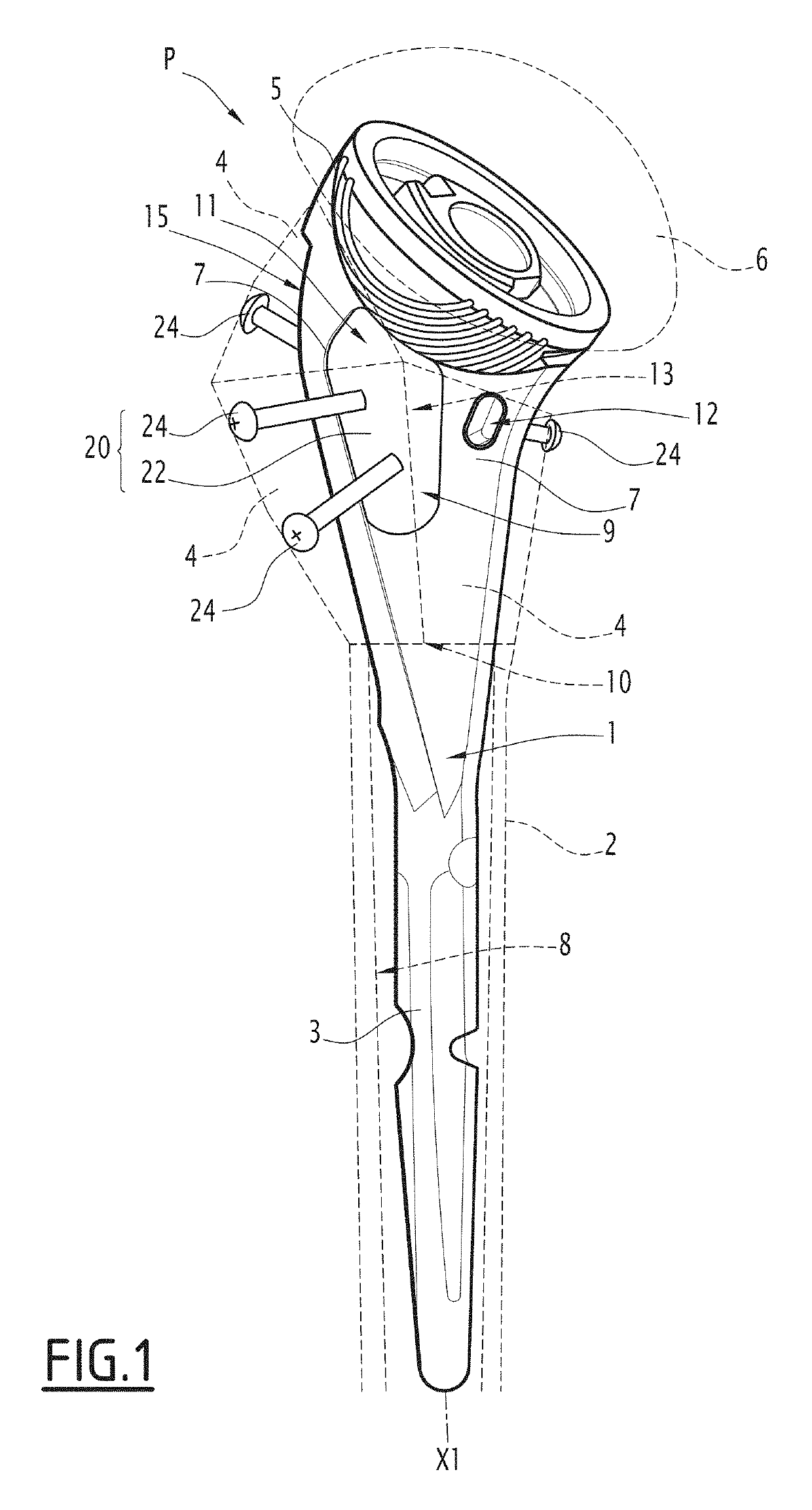 Prosthesis for a fractured long bone