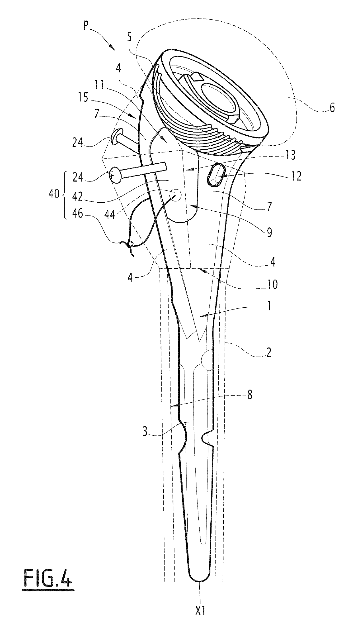 Prosthesis for a fractured long bone