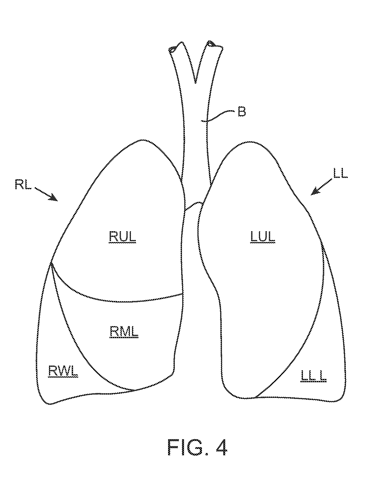 Methods and systems for occluding collateral flow channels in the lung