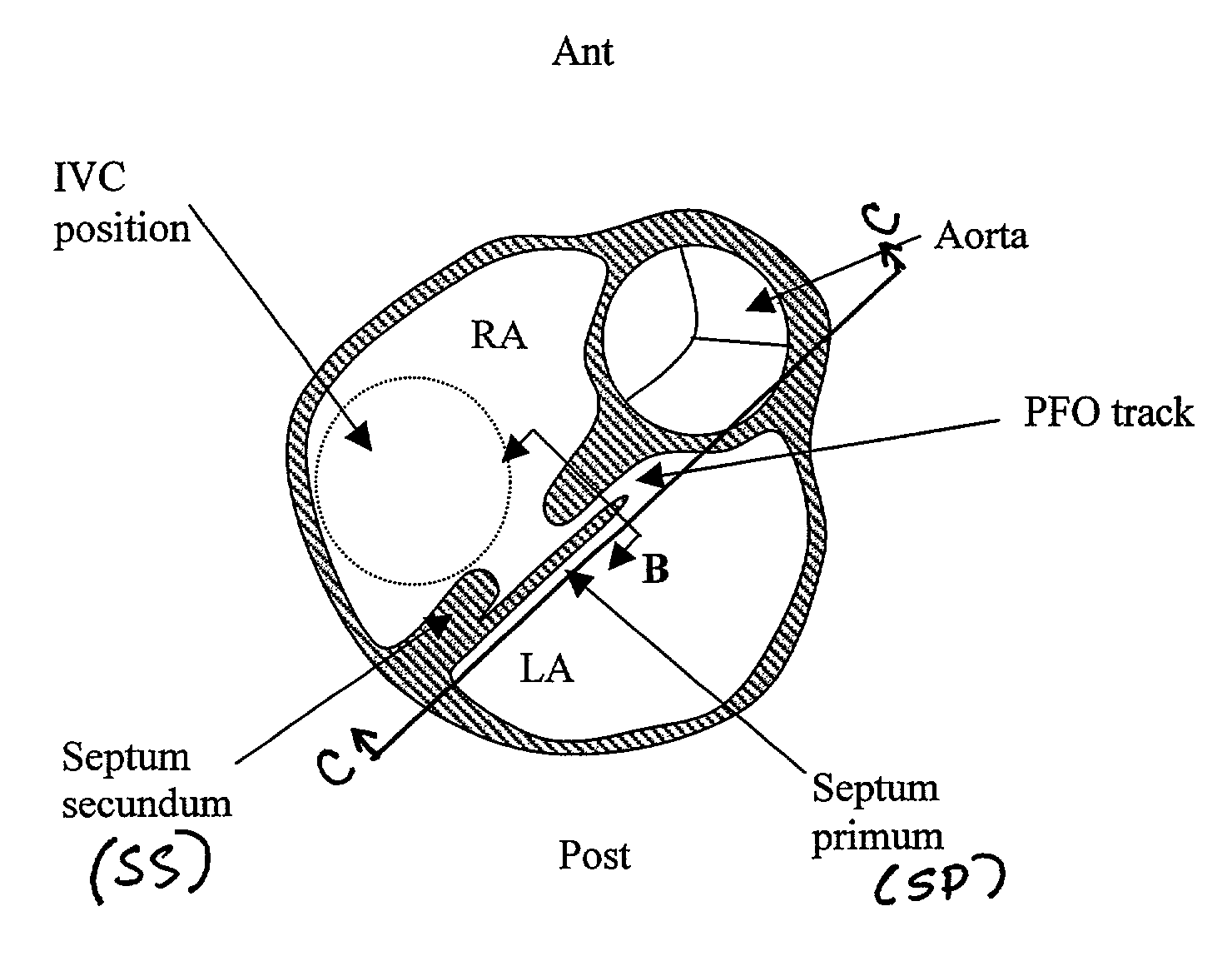 PFO closure devices and related methods of use