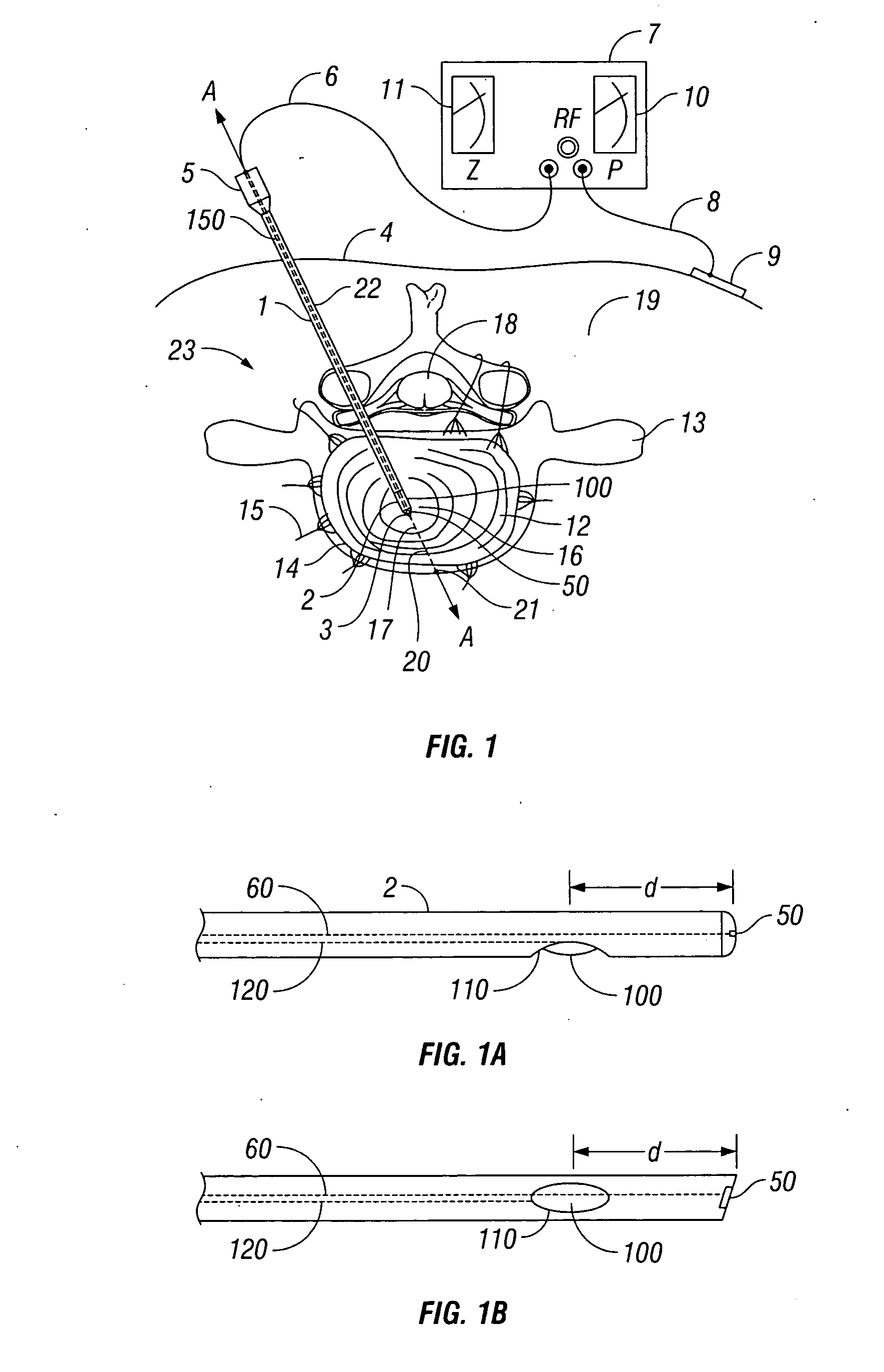 Method and apparatus for monitoring disc pressure during heat treatment of an intervertebral disc