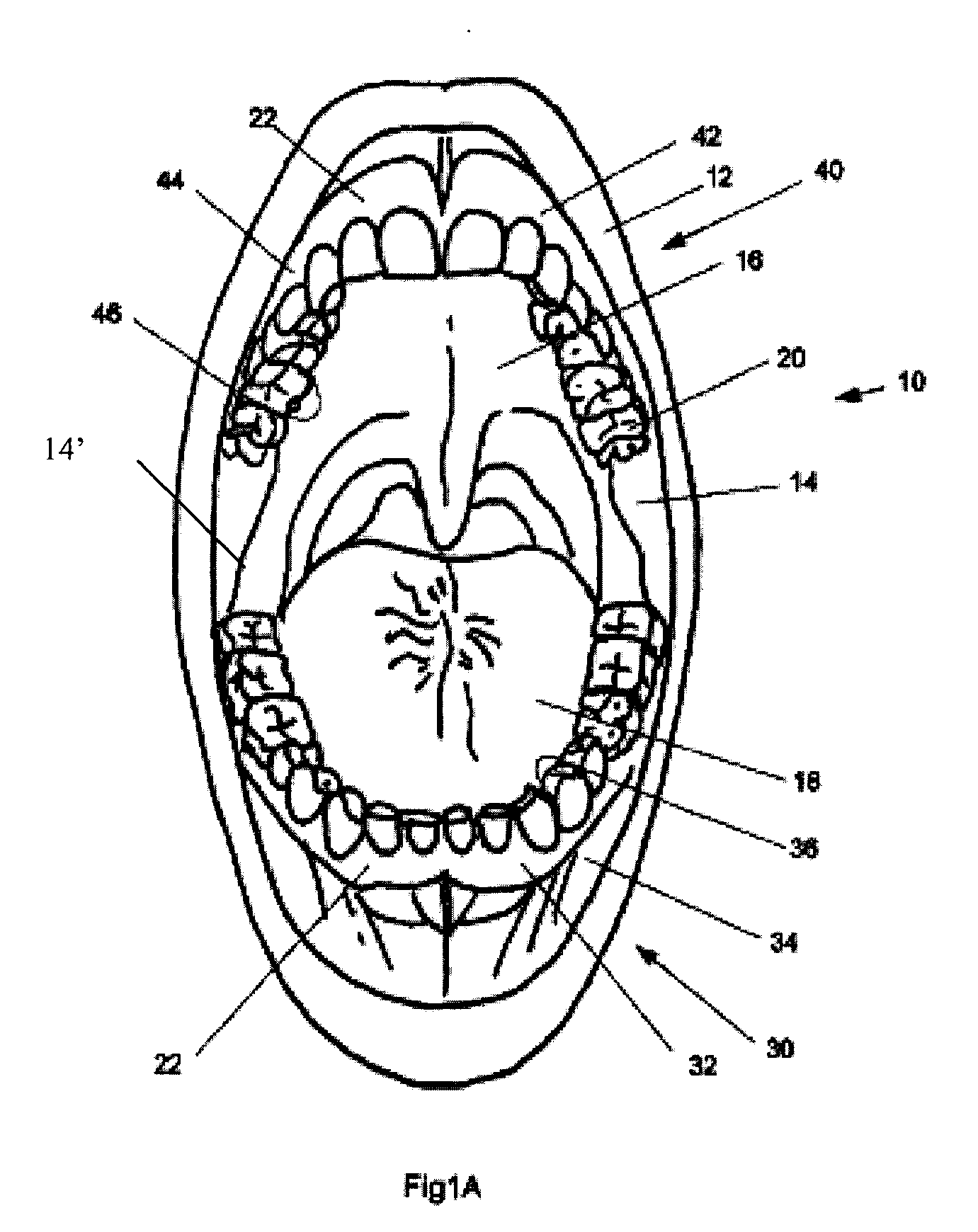 Methods, devices, systems, assemblies, and kits for tissue retraction in an oral cavity