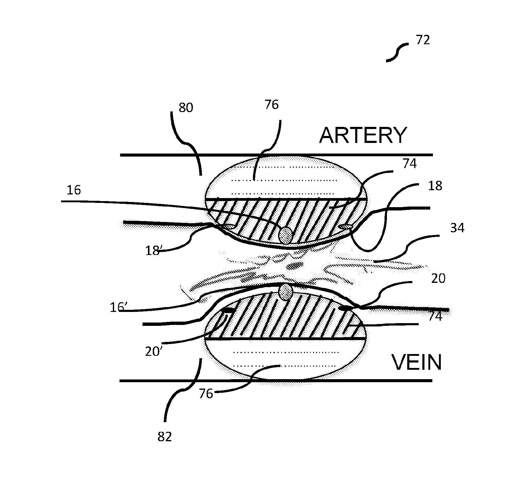 Dual catheter ablation system