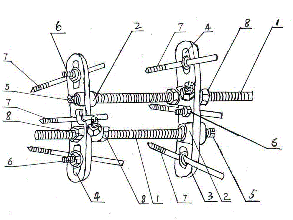 Medical hand and foot bone and patellar fracture malformation correction external fixator