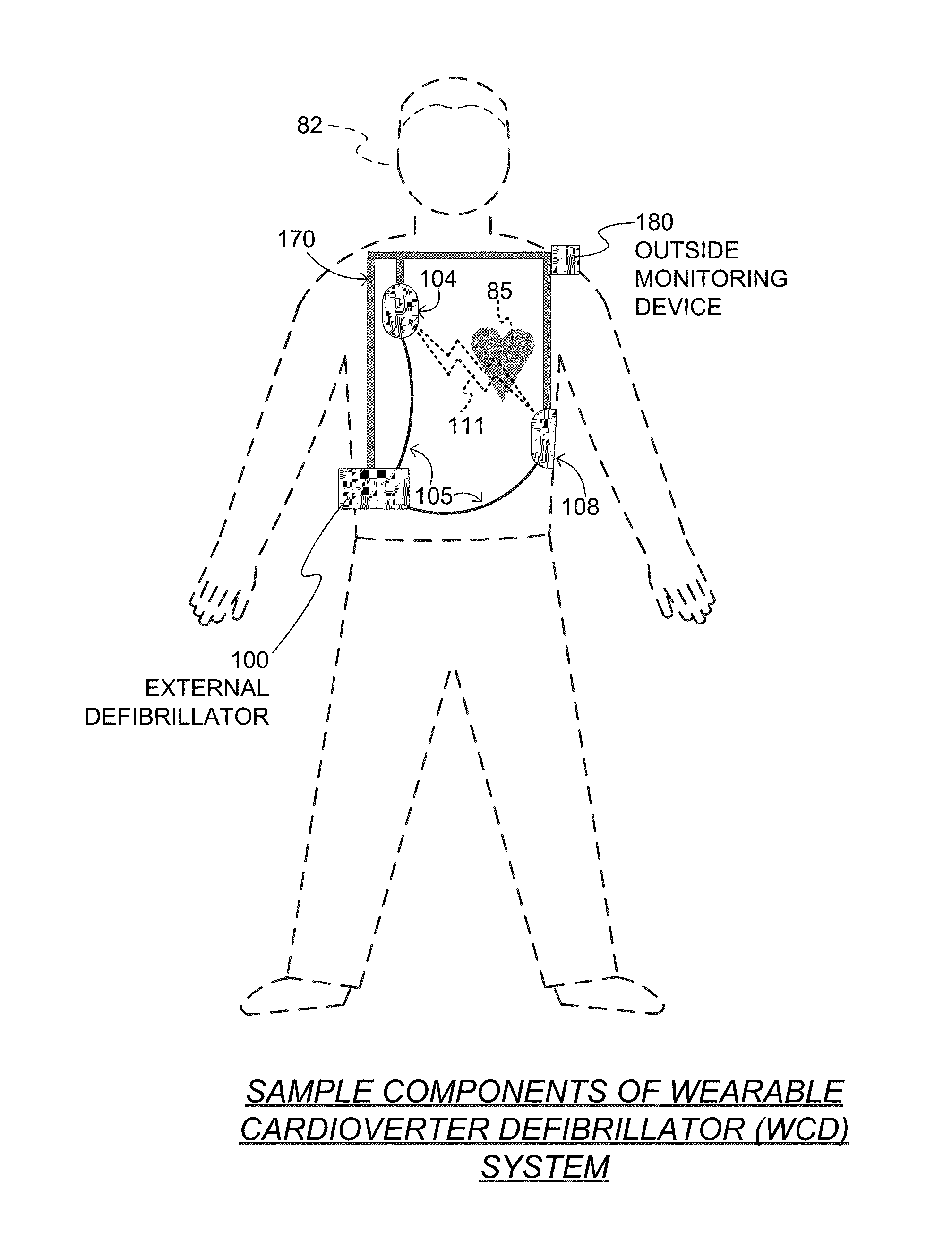 Wearable cardioverter defibrillator (WCD) system informing patient that it is validating just-detected cardiac arrhythmia