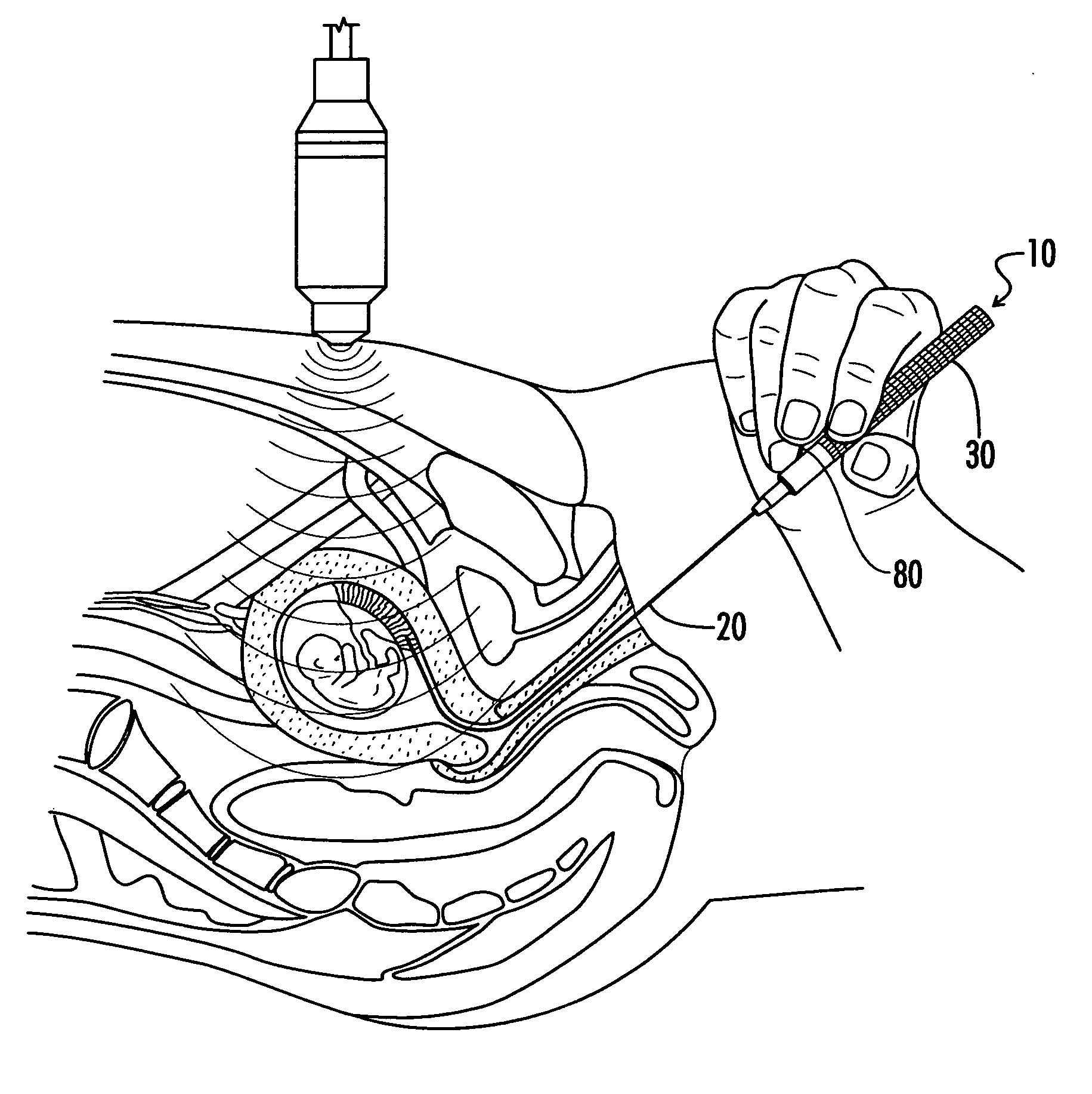 Chorionic villus sampling catheter