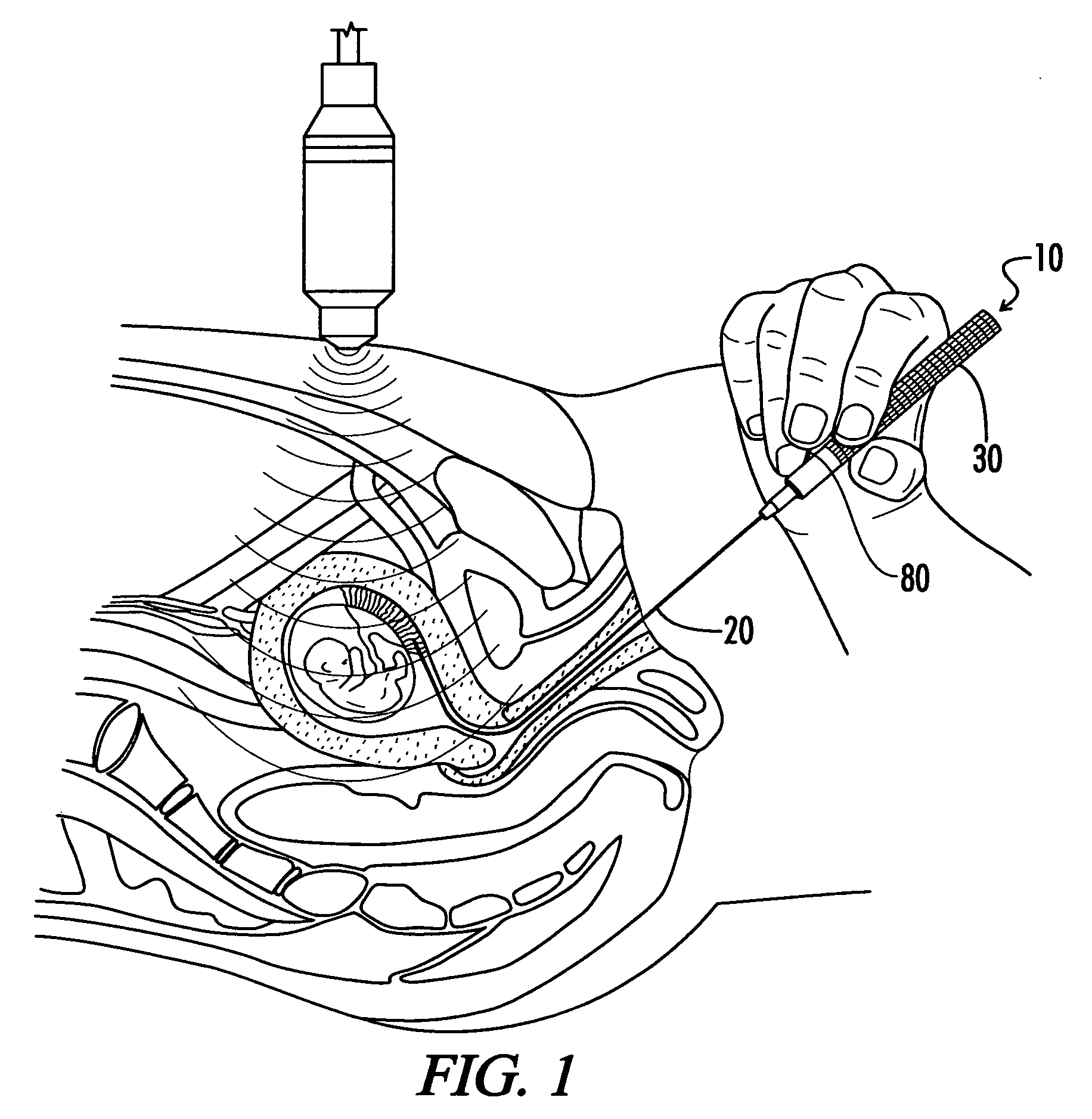 Chorionic villus sampling catheter