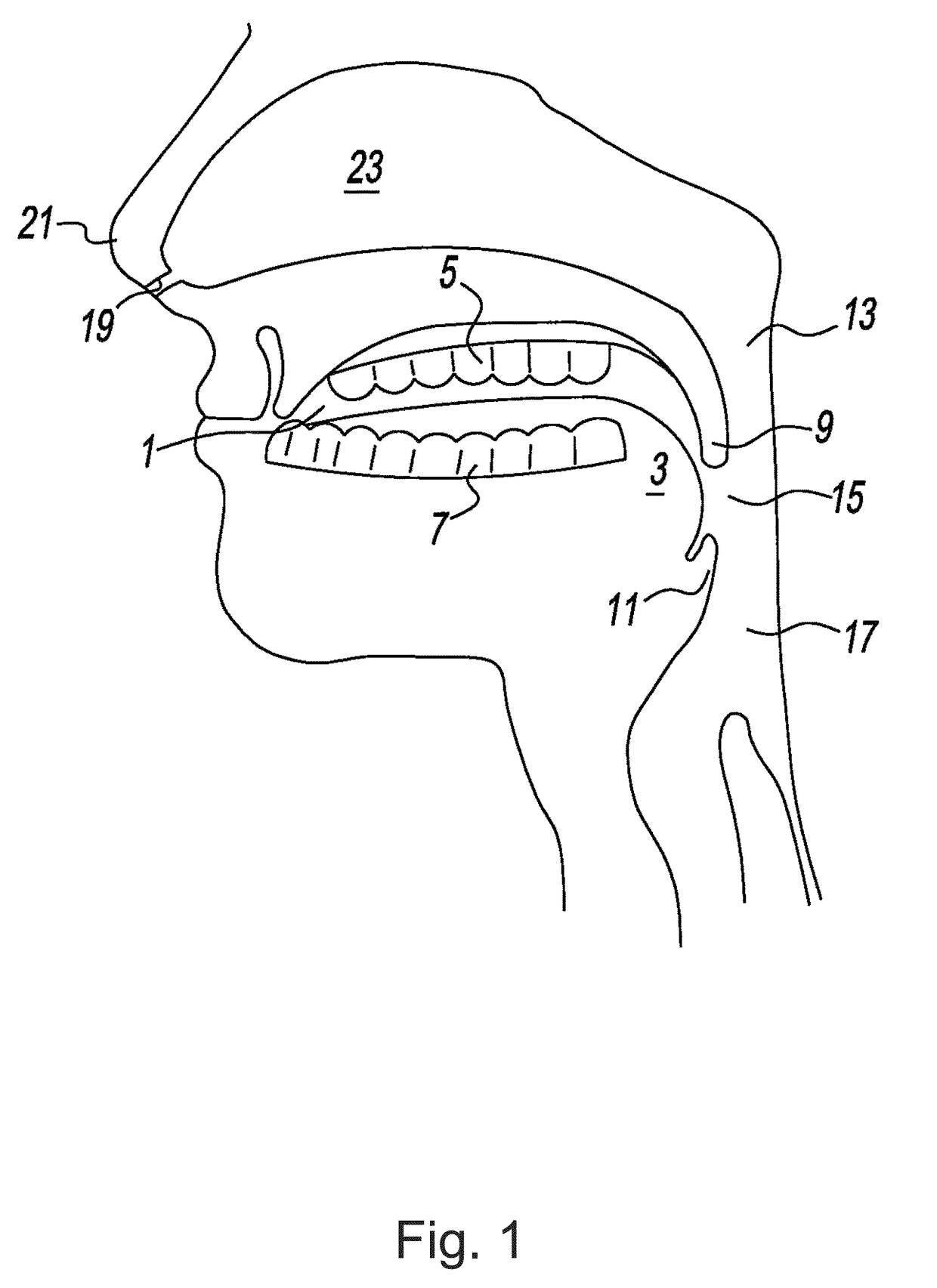 Apparatus and methods for the treatment of sleep apnea