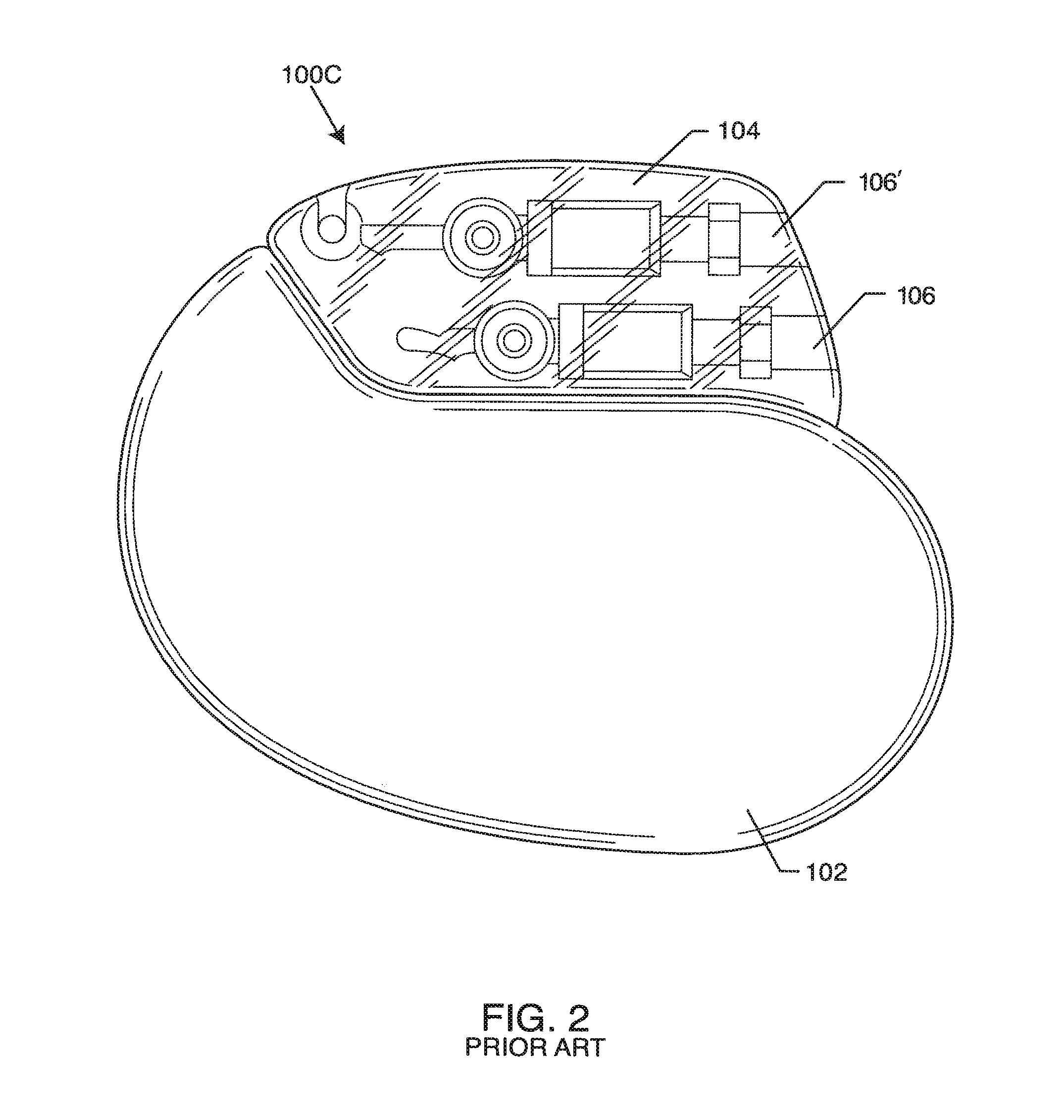 Elevated Hermetic Feedthrough Insulator Adapted for Side Attachment of Electrical Conductors on the Body Fluid Side of an Active Implantable Medical Device