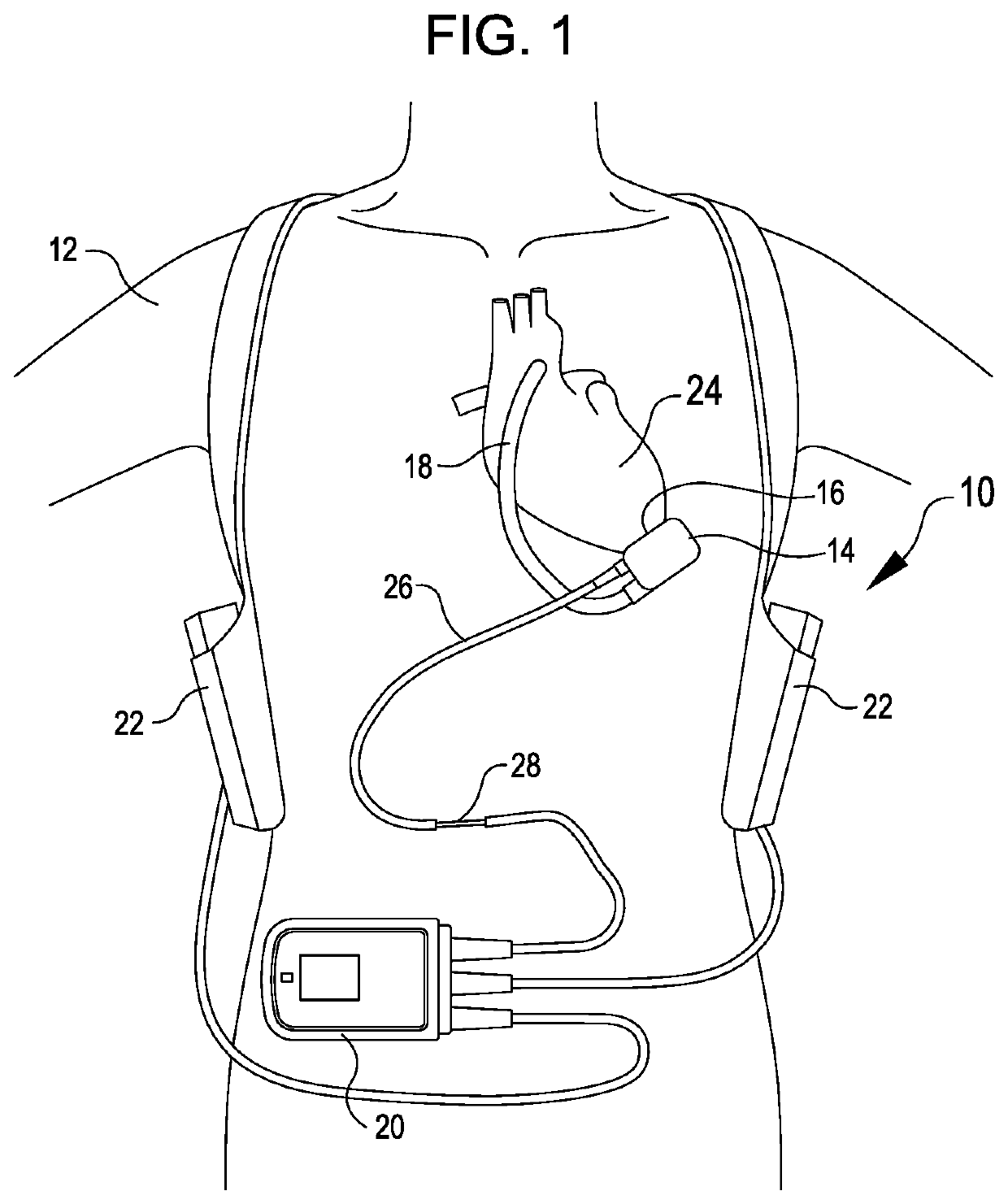 Systems and methods for inertial sensing for VAD diagnostics and closed loop control