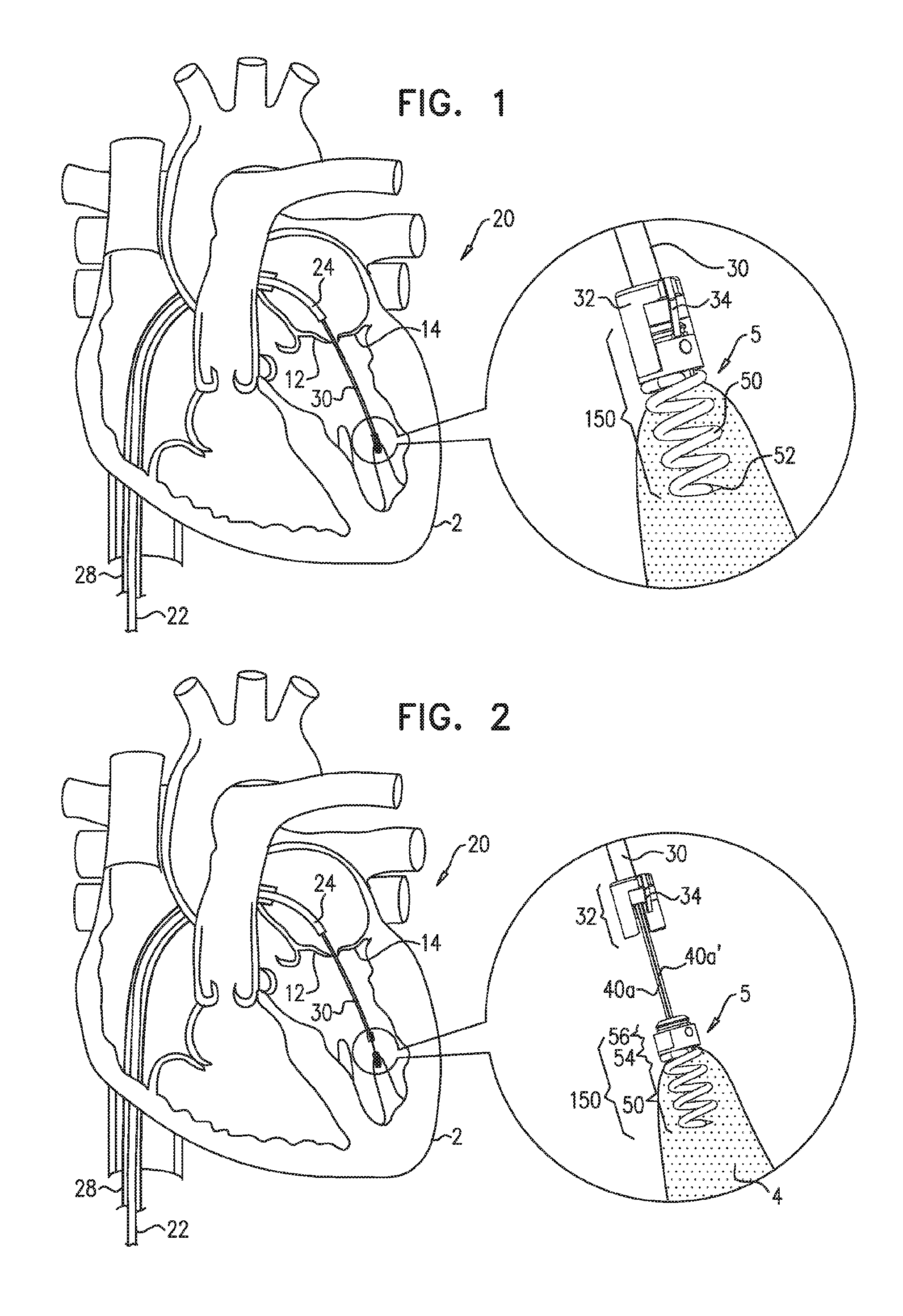 Techniques for guide-wire based advancement of a tool