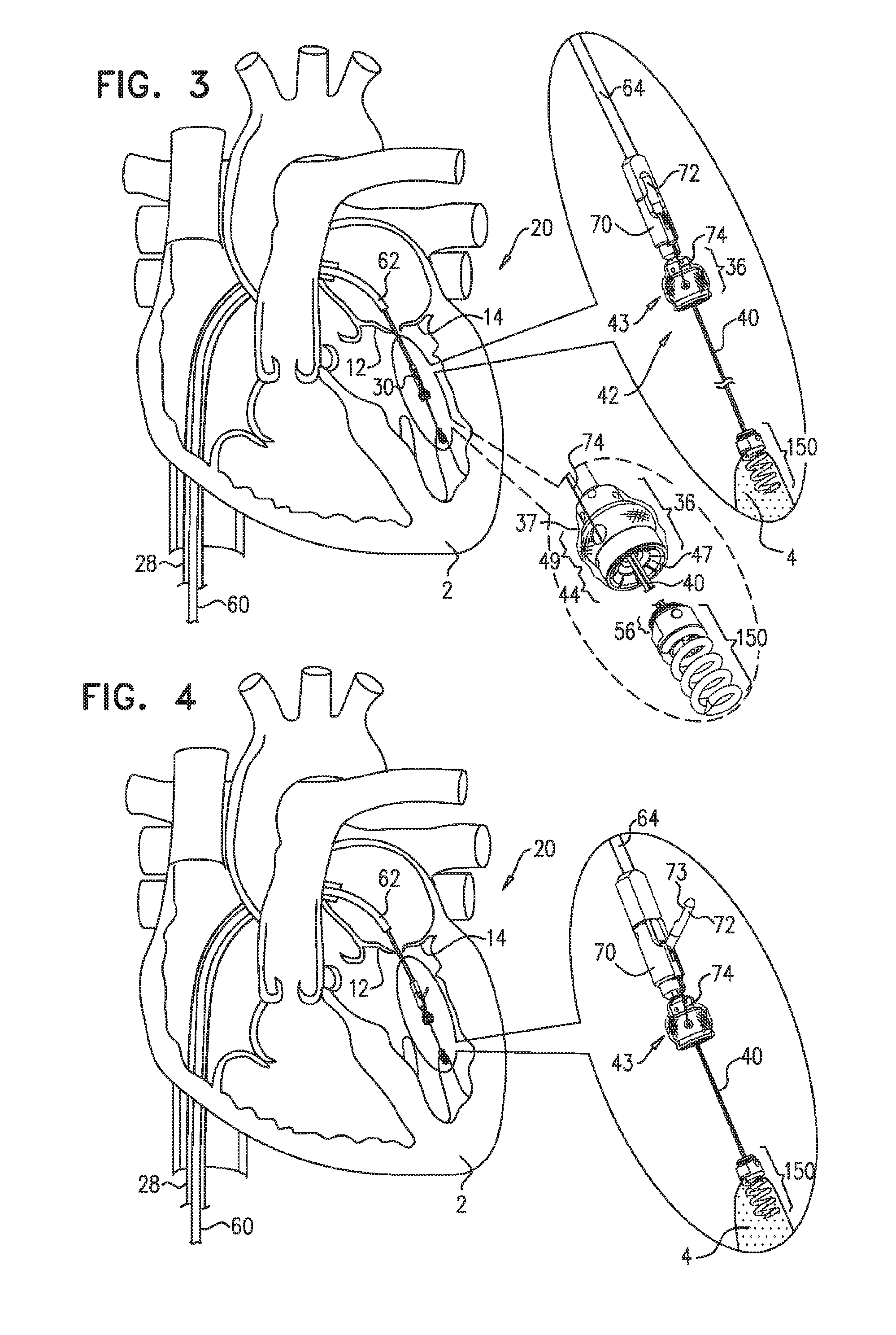 Techniques for guide-wire based advancement of a tool