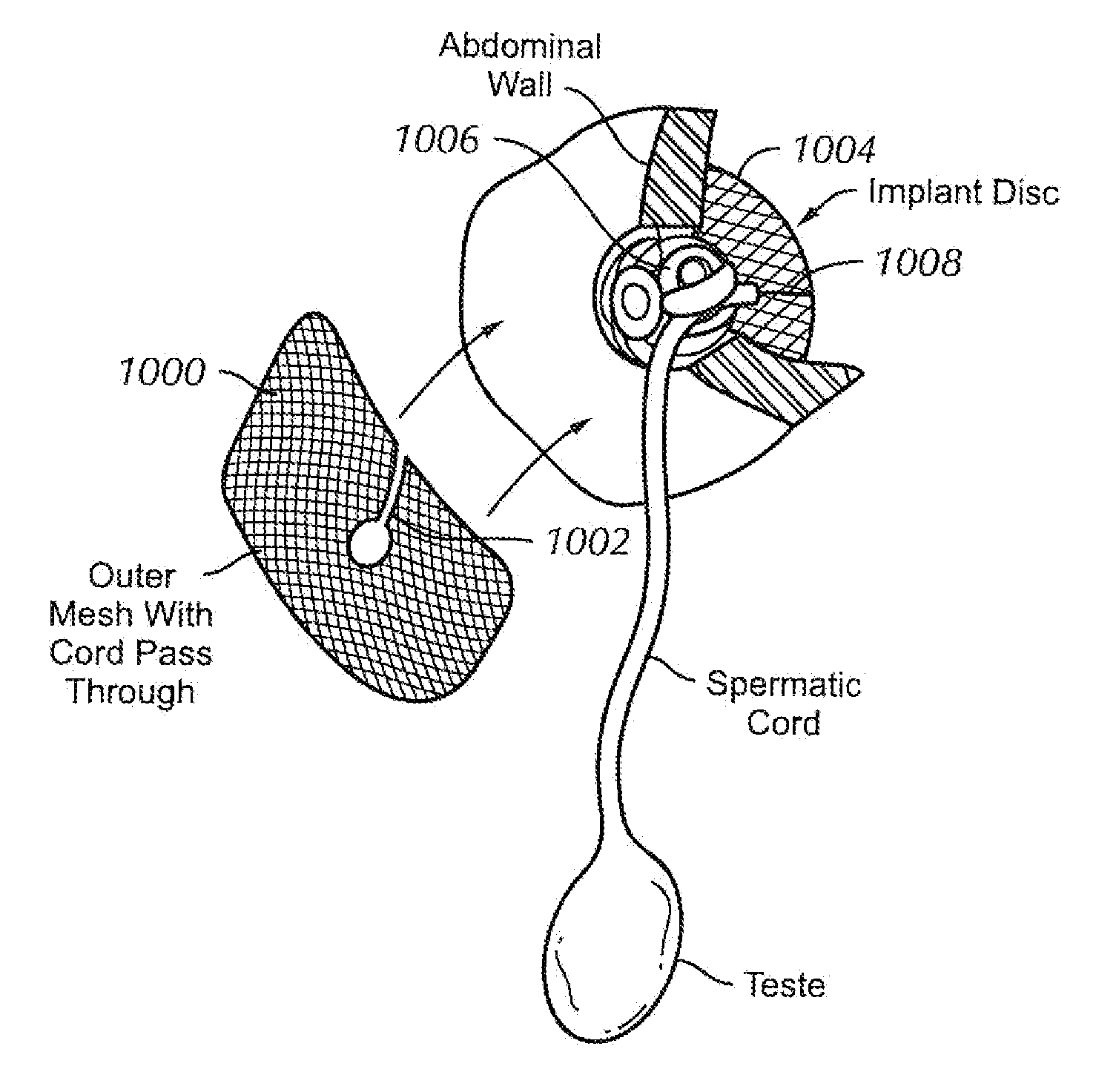 Repair of defect in inguinal canal and other muscular structures