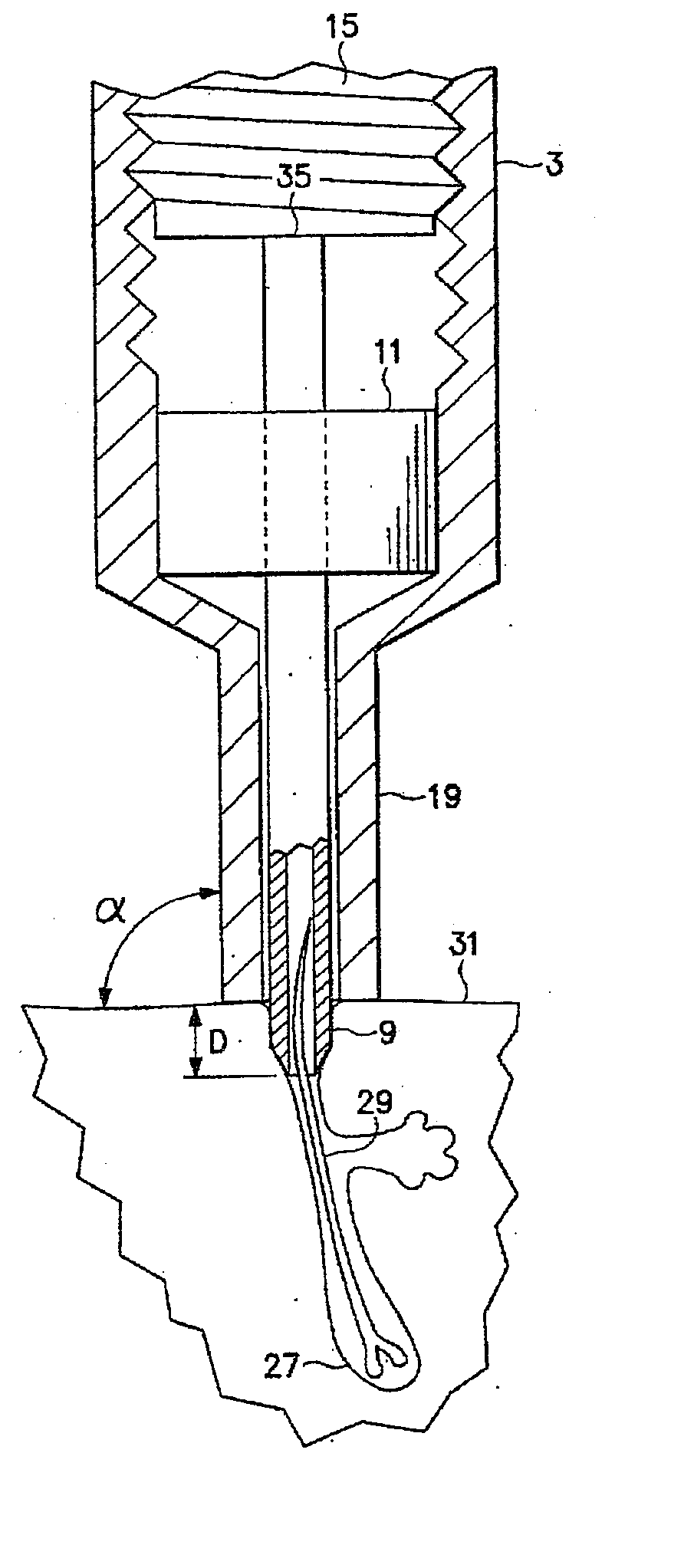 Follicular extraction punch and method