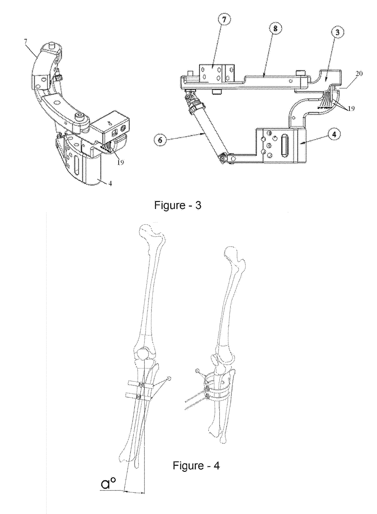 High tibial osteotomy external fixator