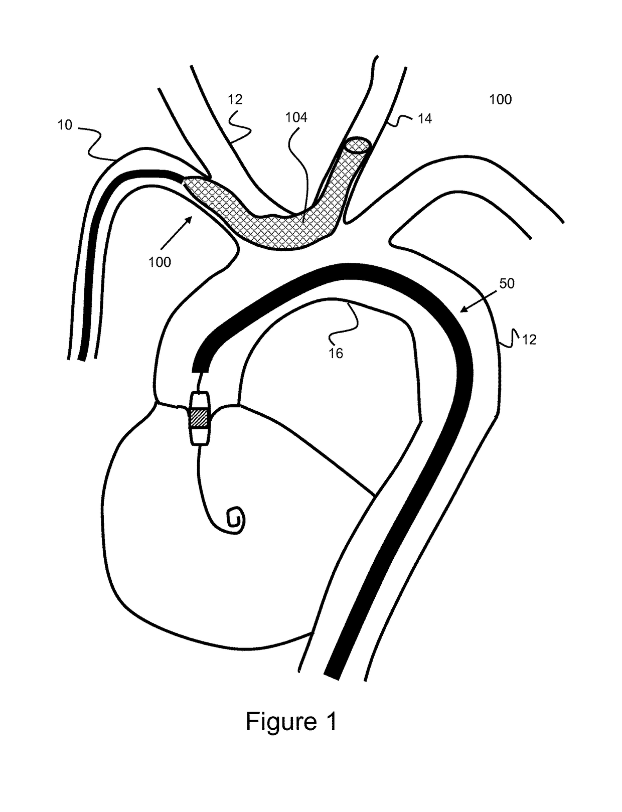 Methods and devices for embolic protection