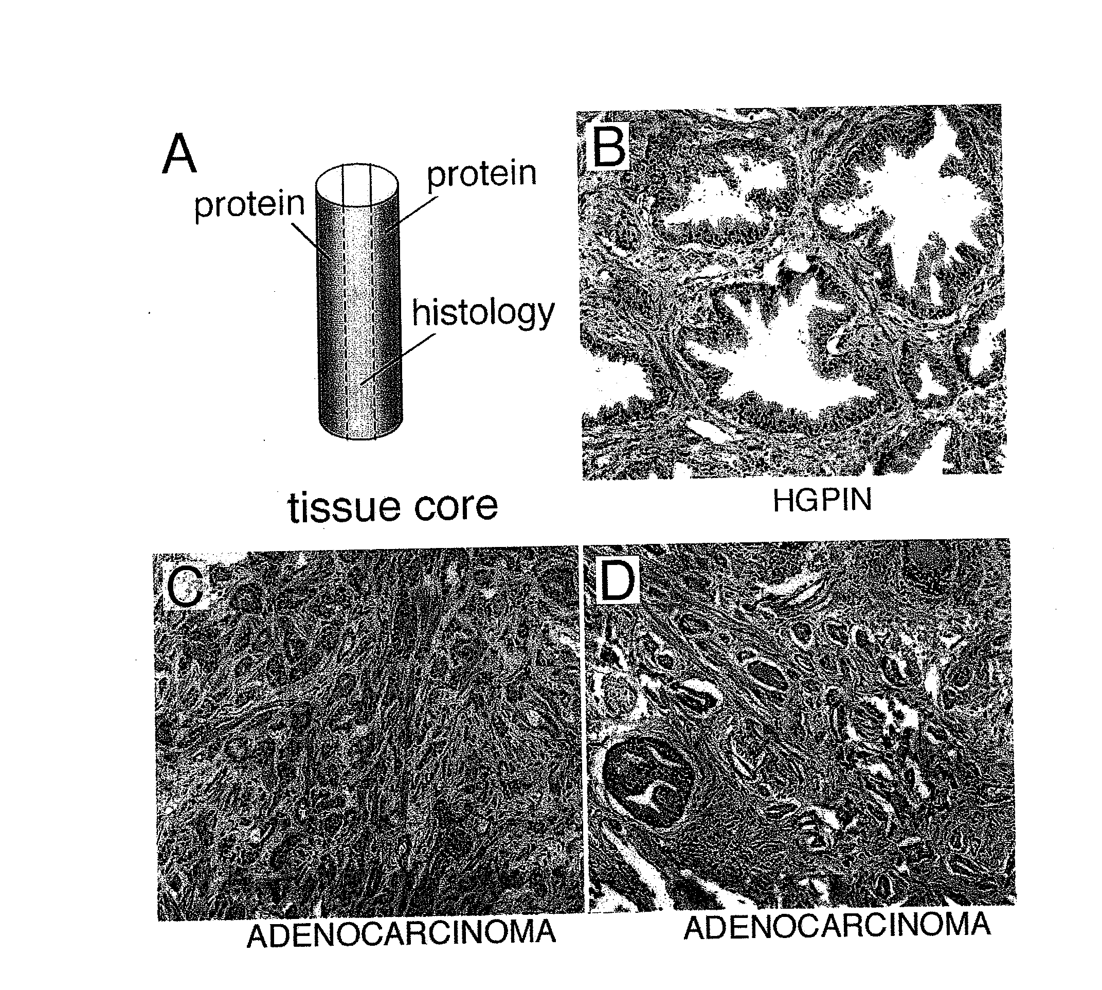 Methods for predicting prostate cancer recurrence