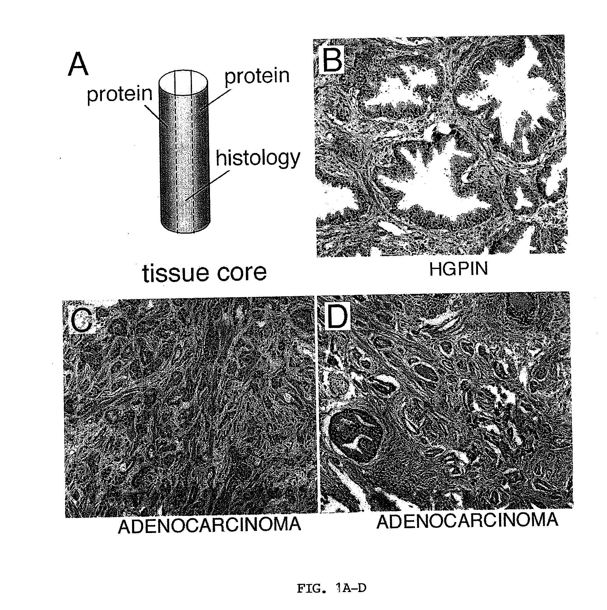 Methods for predicting prostate cancer recurrence