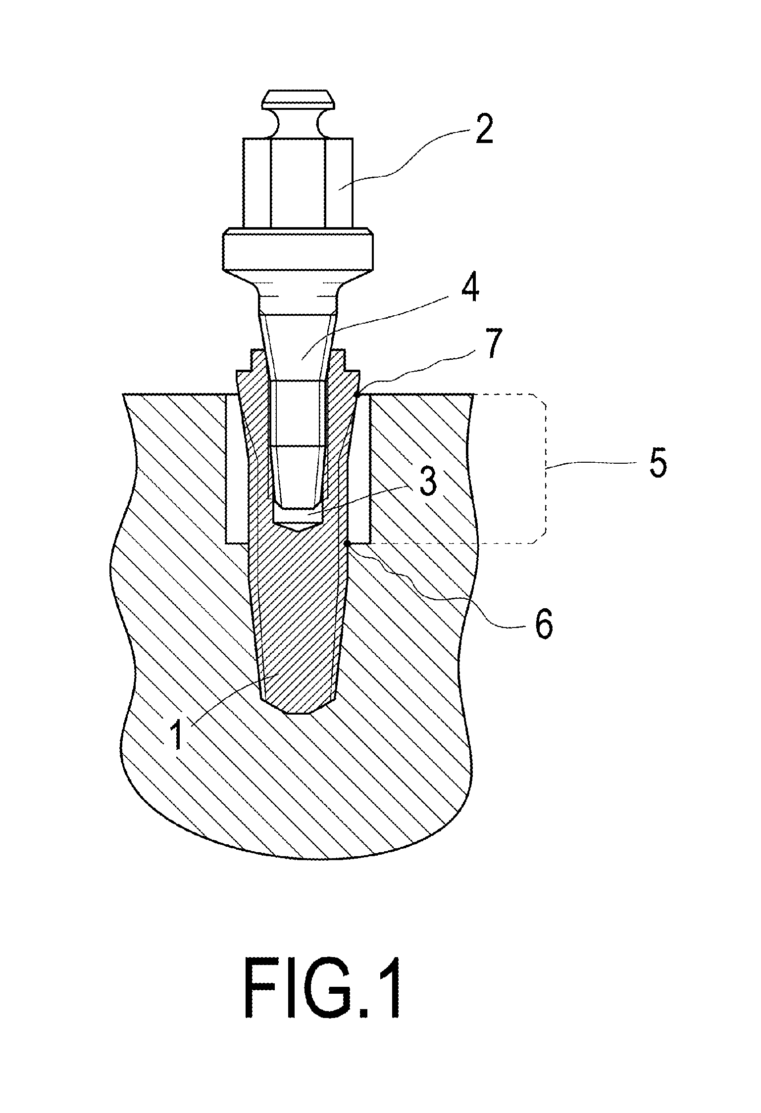 Implant extraction method and trephine drill bit for enabling the extraction