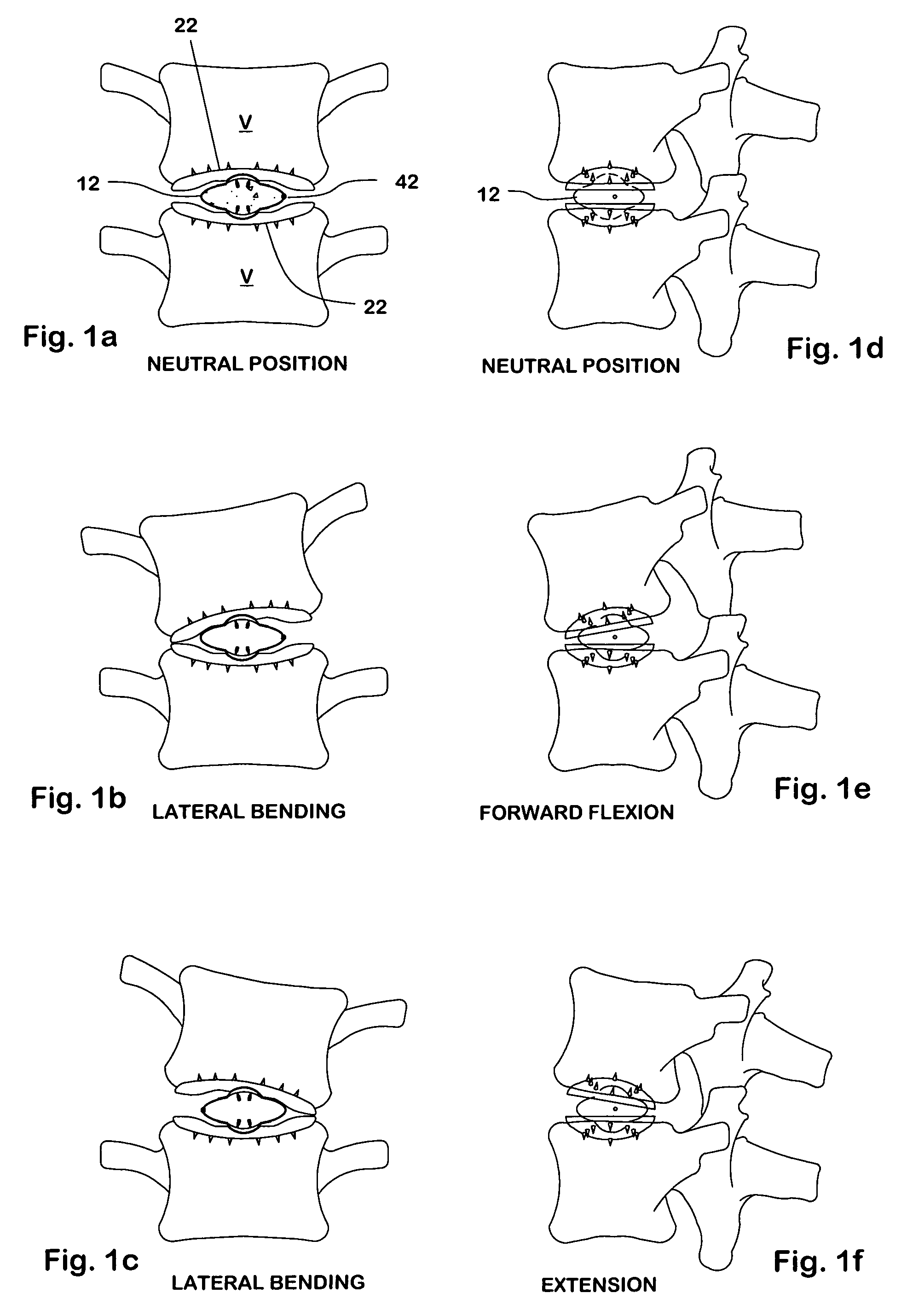 Inflatable intervertebral disc replacement prosthesis