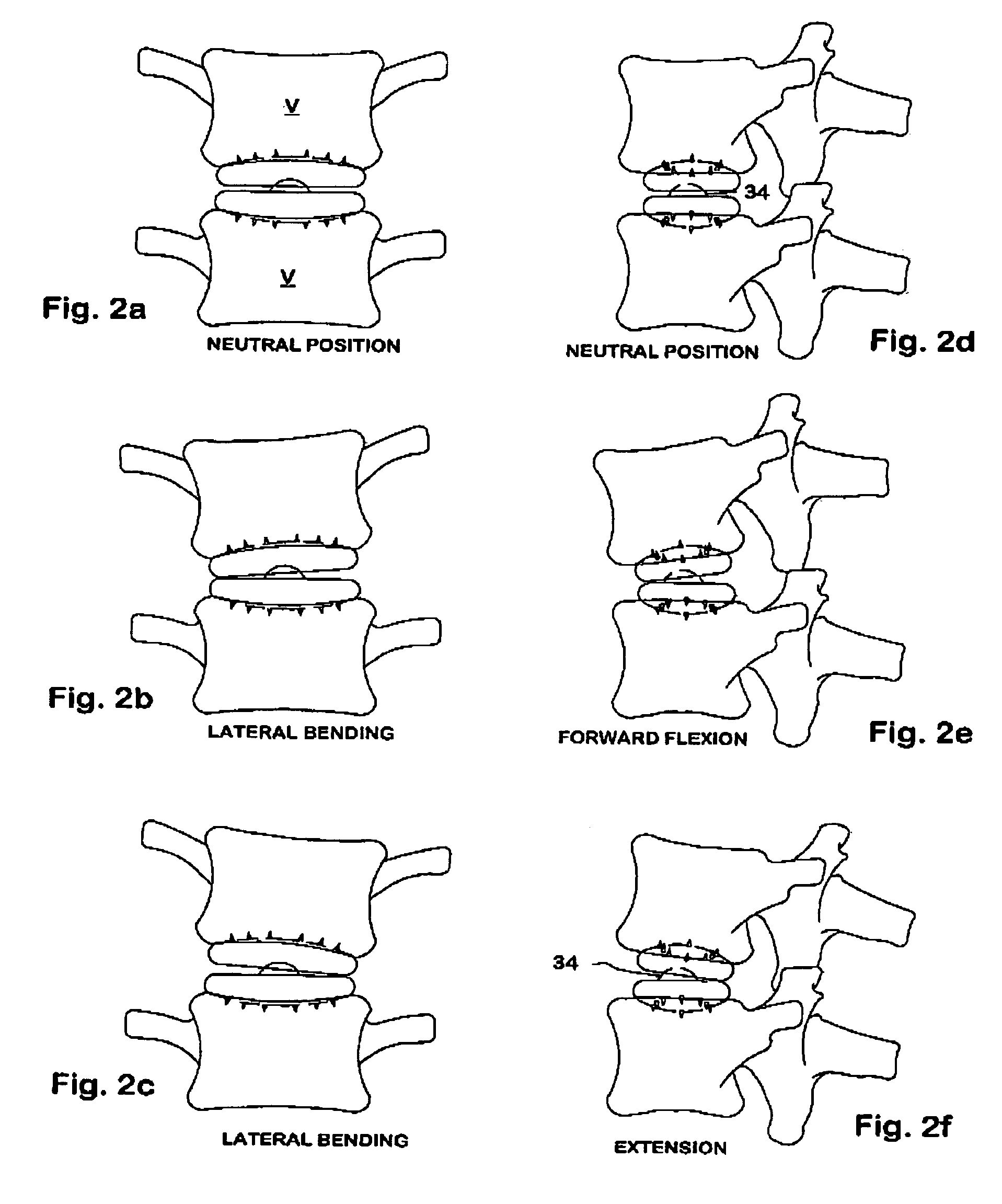 Inflatable intervertebral disc replacement prosthesis