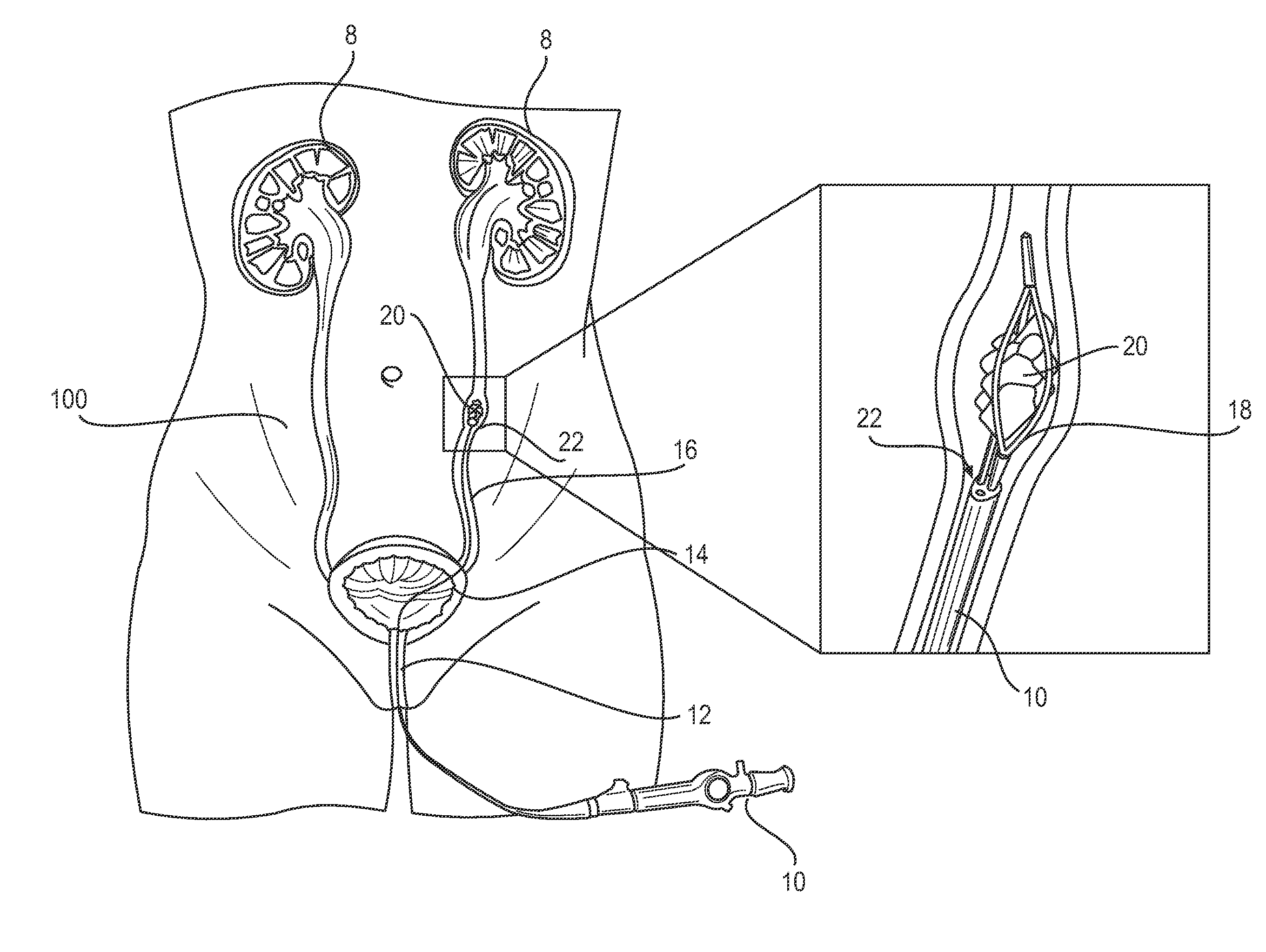 Kidney stone suction device