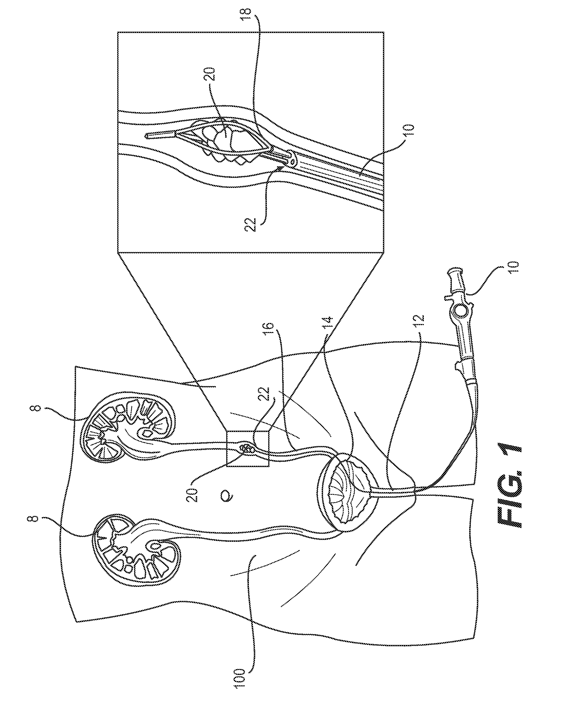 Kidney stone suction device