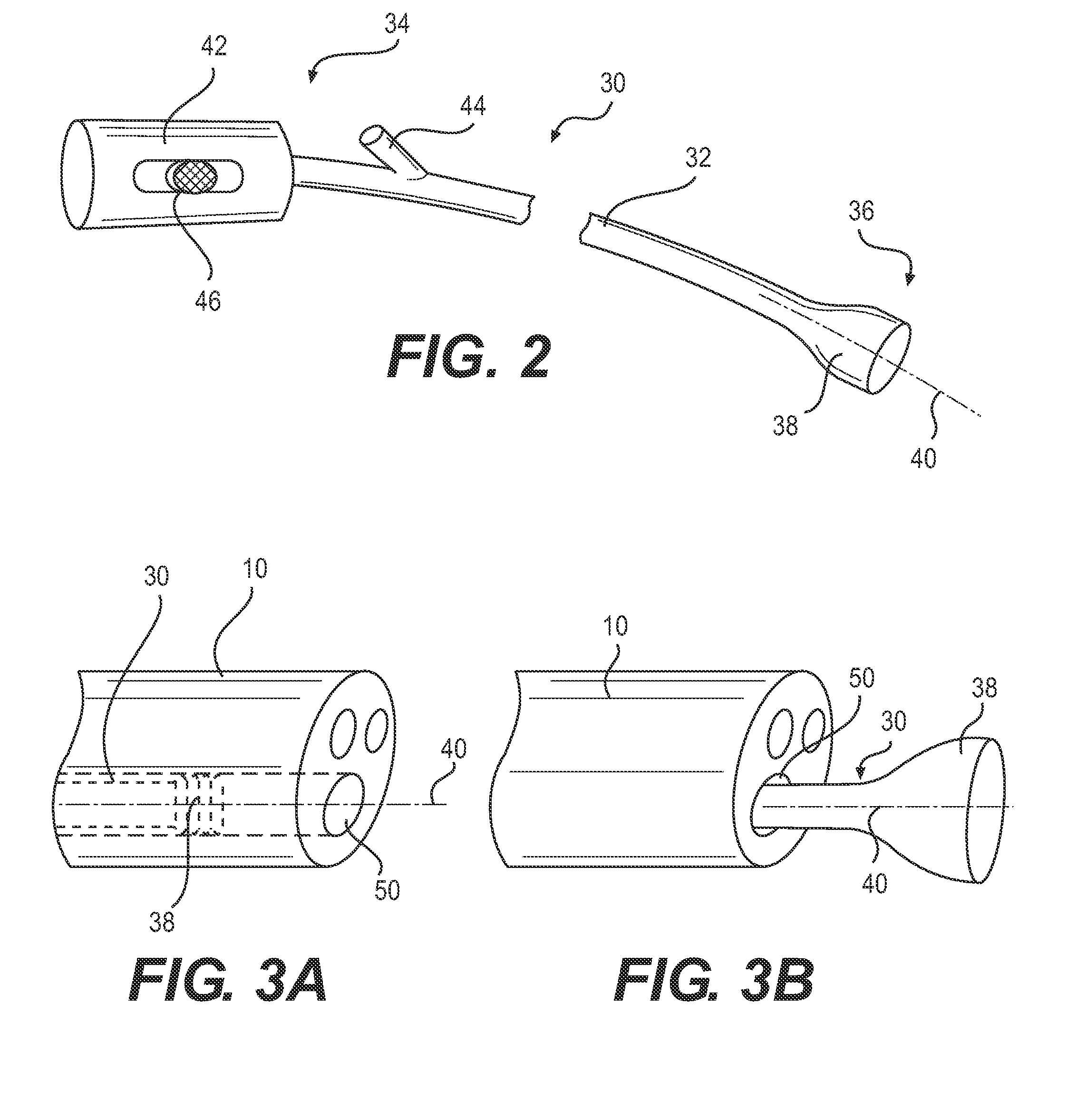 Kidney stone suction device