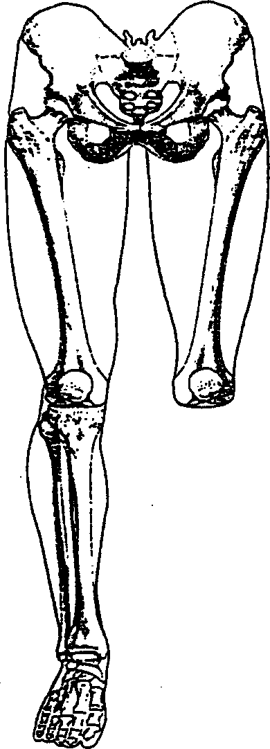 Artificial meromelia extremity and its making and installing process