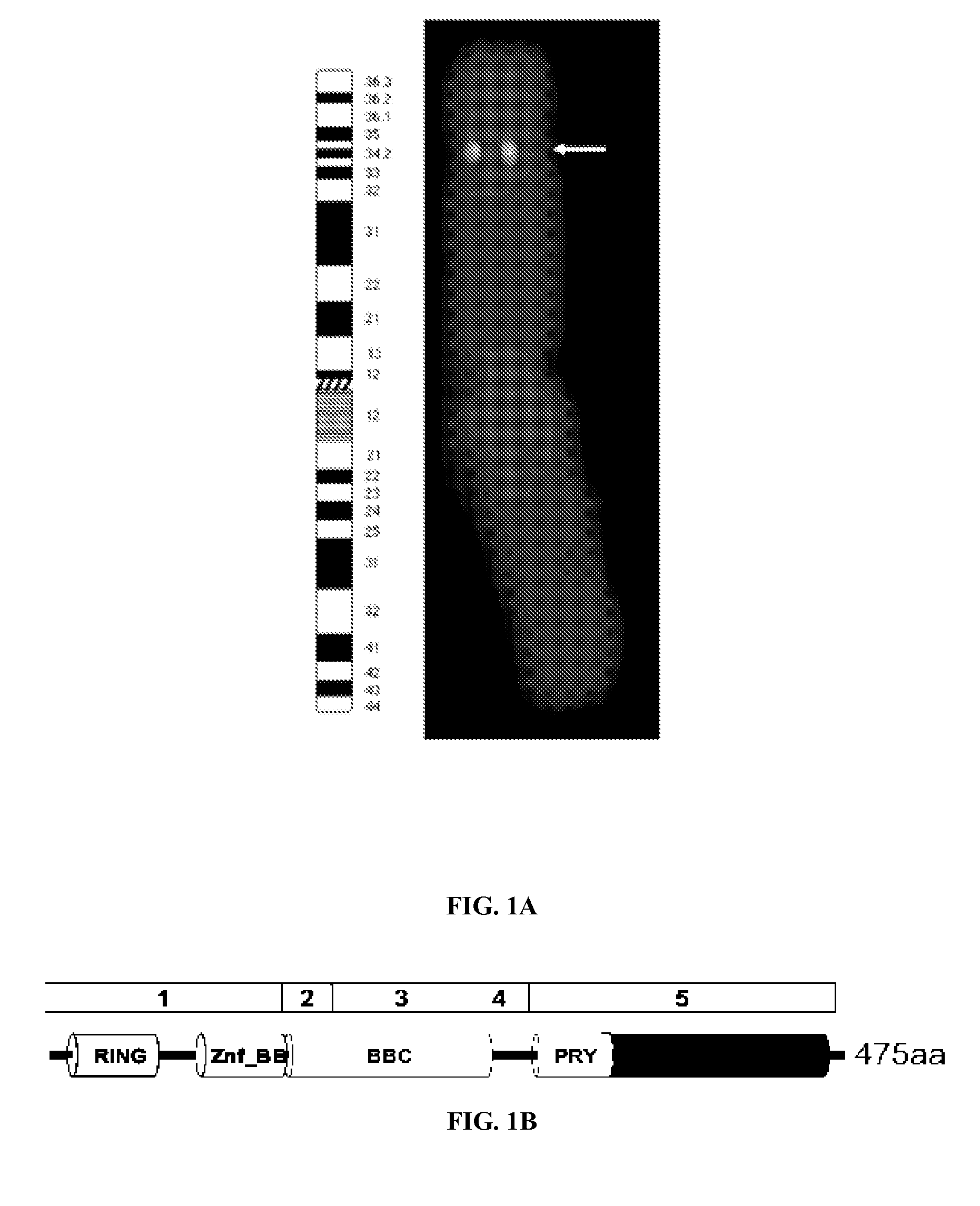 Assay for the detection of recurrence in breast cancer using the novel tumor suppressor dear1