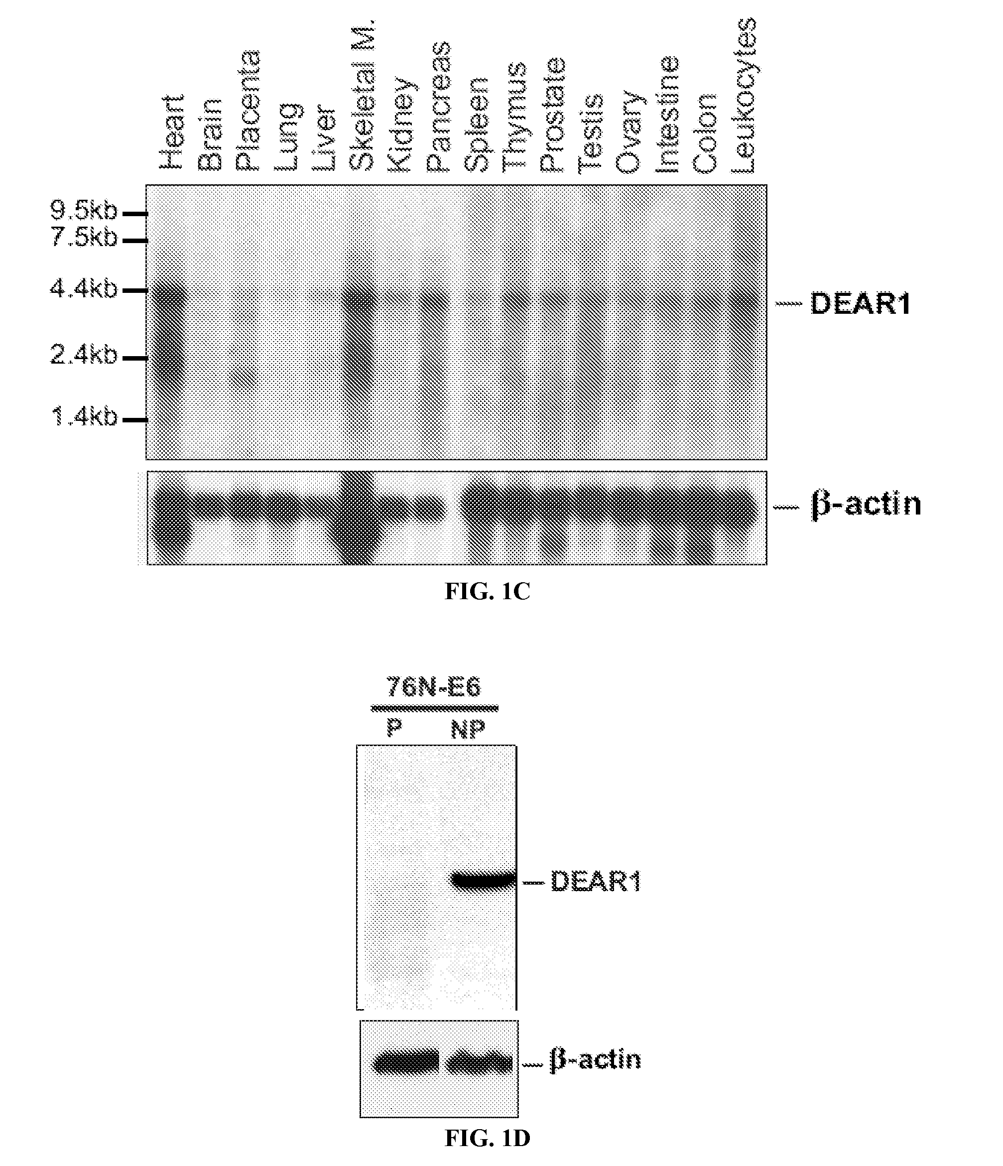 Assay for the detection of recurrence in breast cancer using the novel tumor suppressor dear1