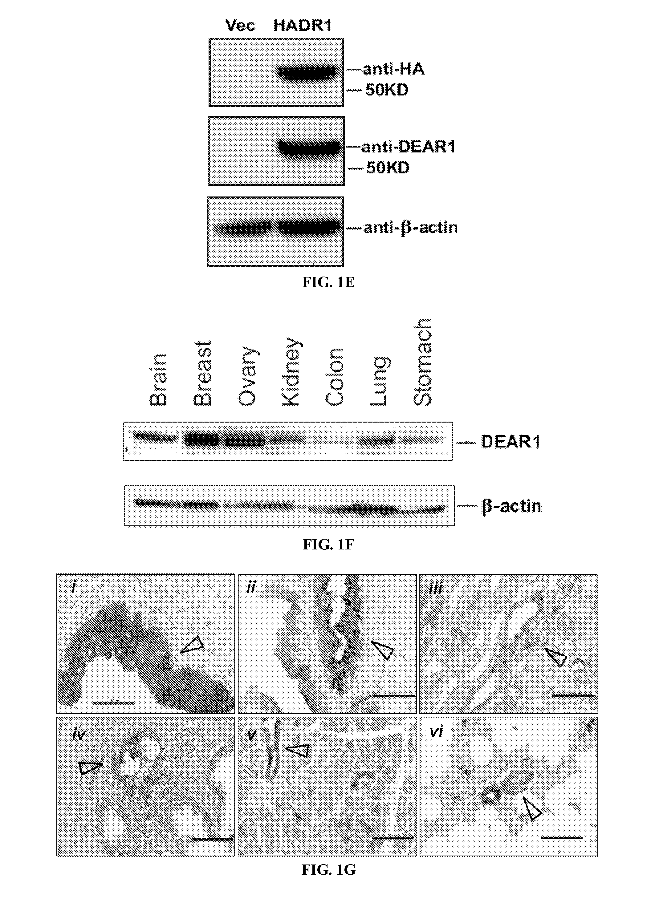 Assay for the detection of recurrence in breast cancer using the novel tumor suppressor dear1