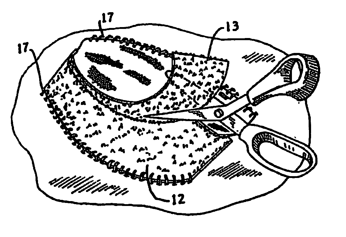 Prosthesis and method for lowering abdominal pressure