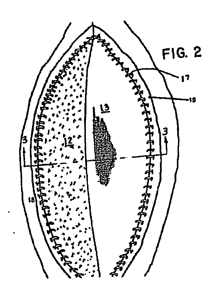 Prosthesis and method for lowering abdominal pressure