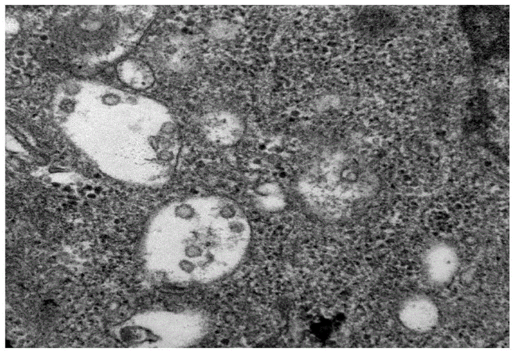 Coxsackievirus and application of coxsackievirus in preparation of anti-tumor drugs