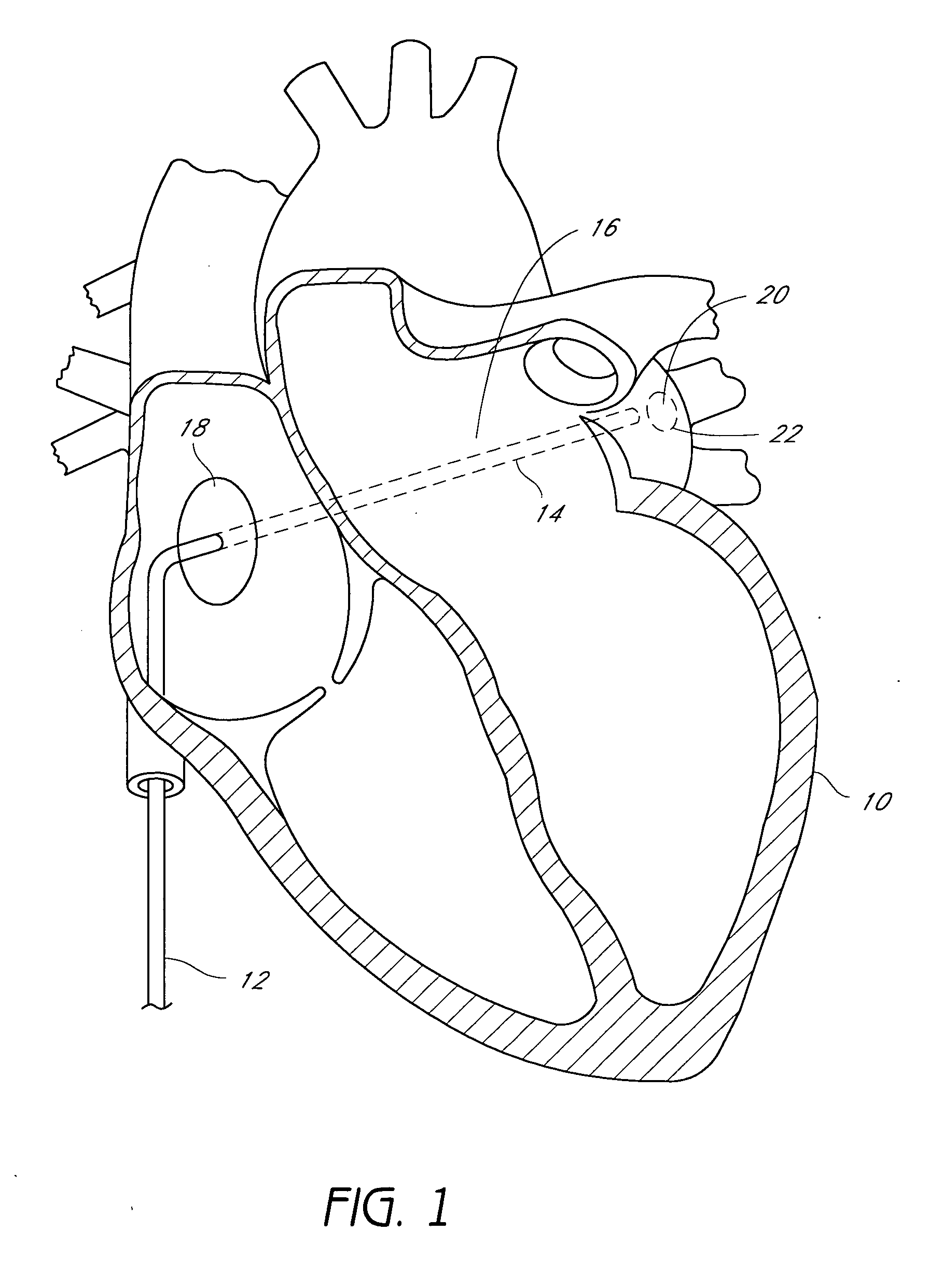 Method for accessing the left atrial appendage with a balloon-tipped transeptal sheath