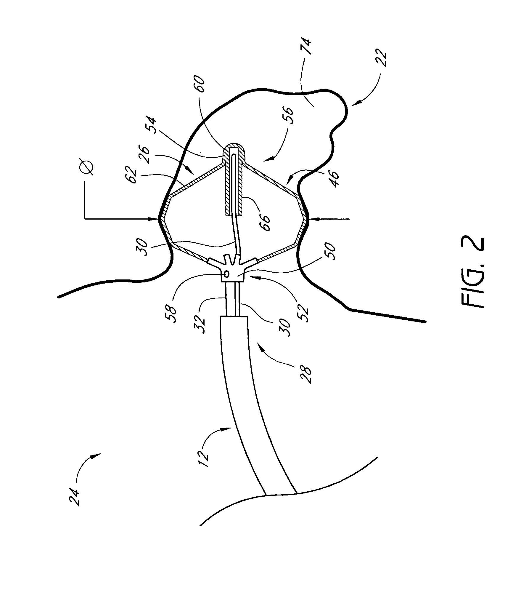 Method for accessing the left atrial appendage with a balloon-tipped transeptal sheath