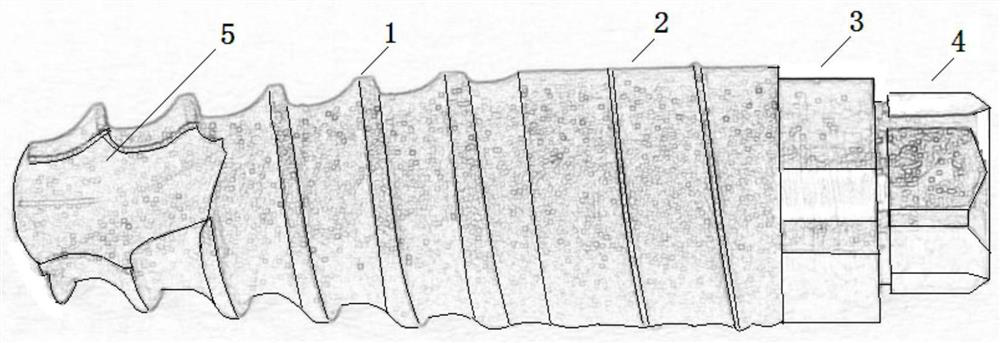 A titanium-based amorphous metal glass dental implant and its preparation method