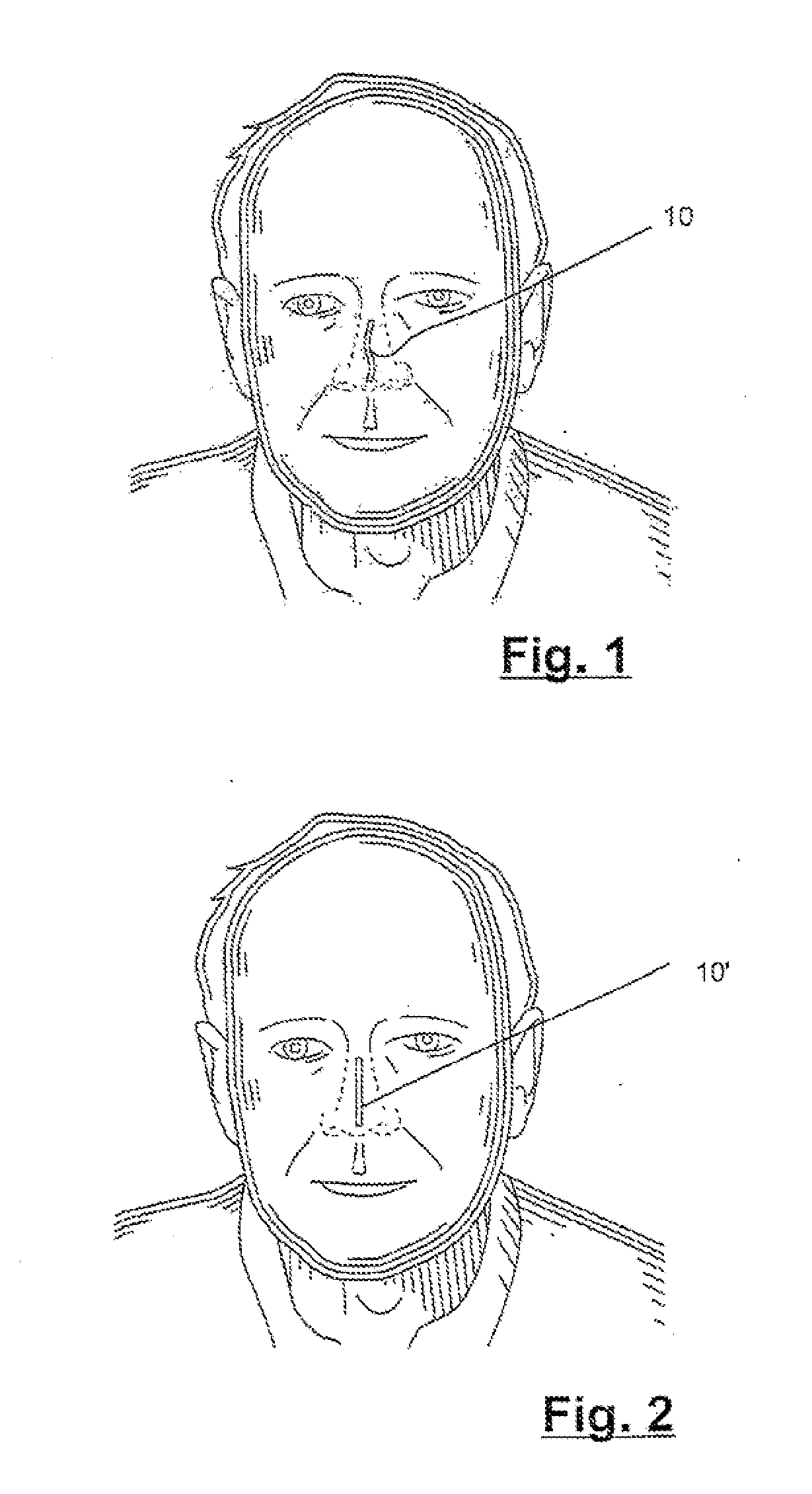 Internally implantable nasal stent