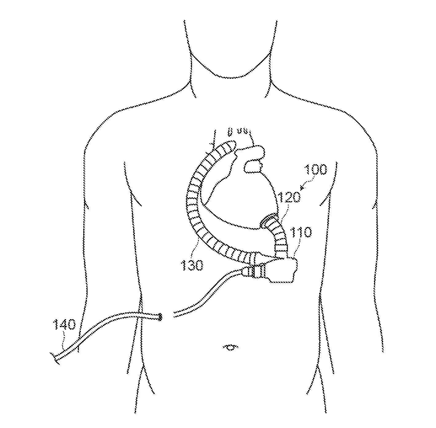 Ventricular assist blood pump