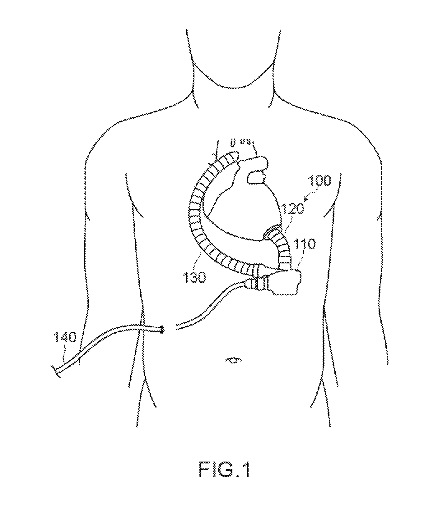 Ventricular assist blood pump