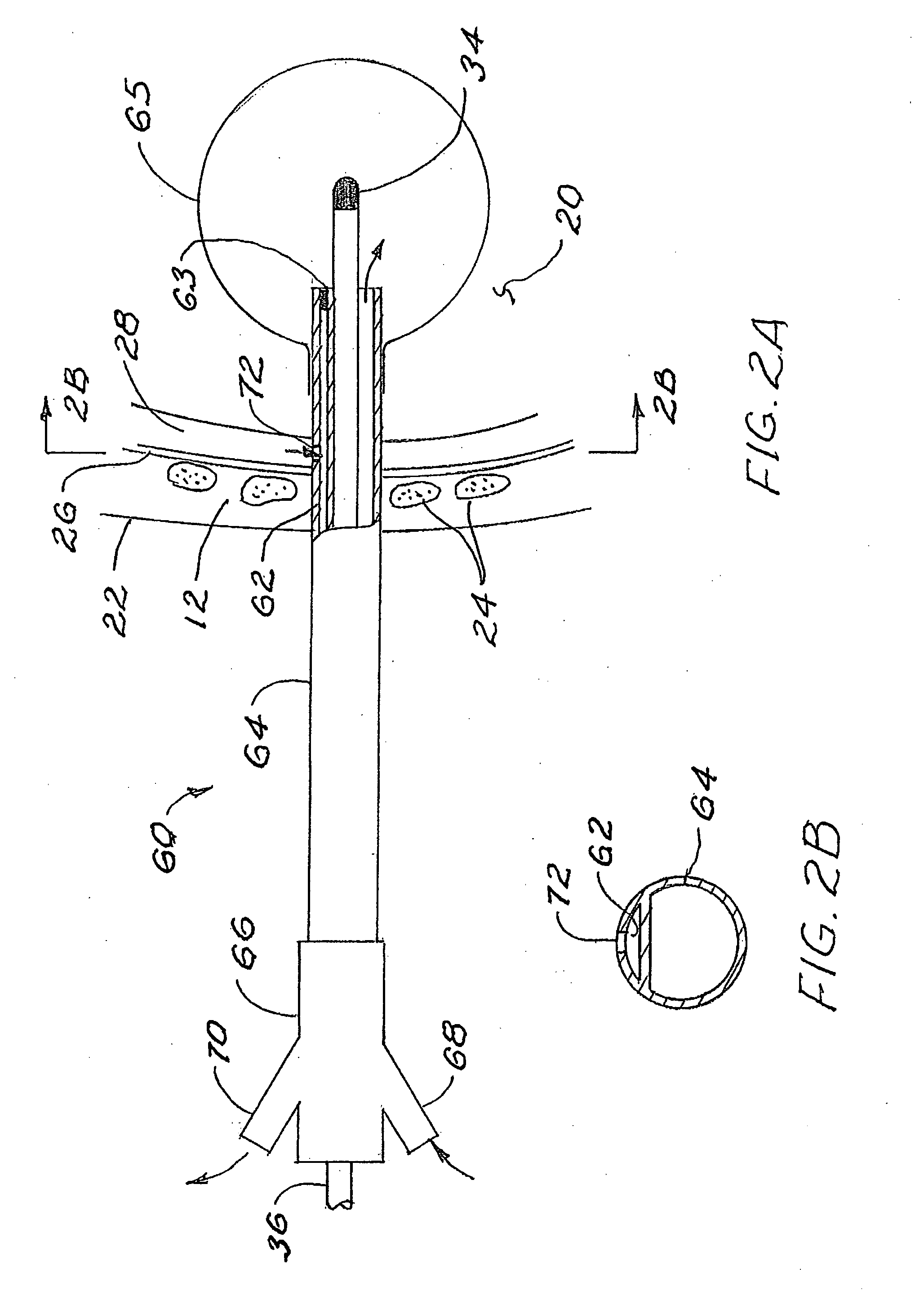 Brachytherapy apparatus and method for use with minimally invasive surgeries of the lung