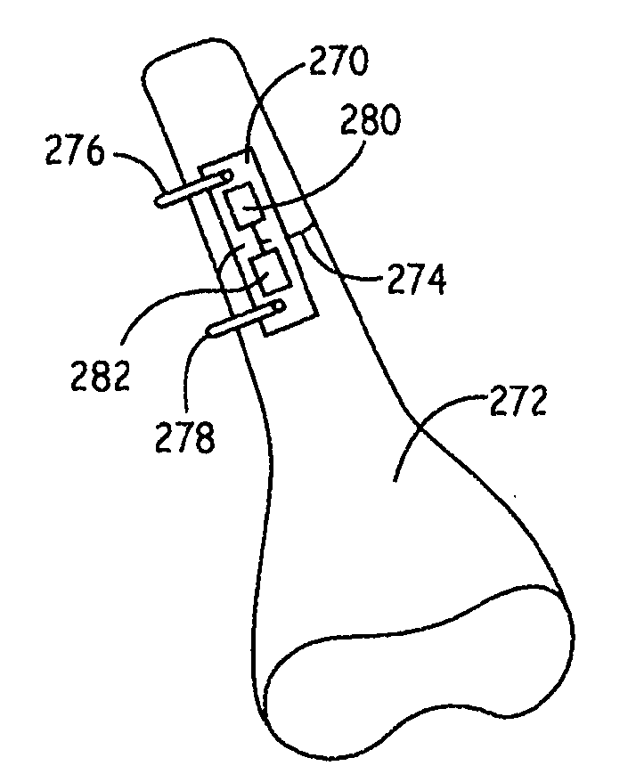 Instrumented orthopedic and other medical implants