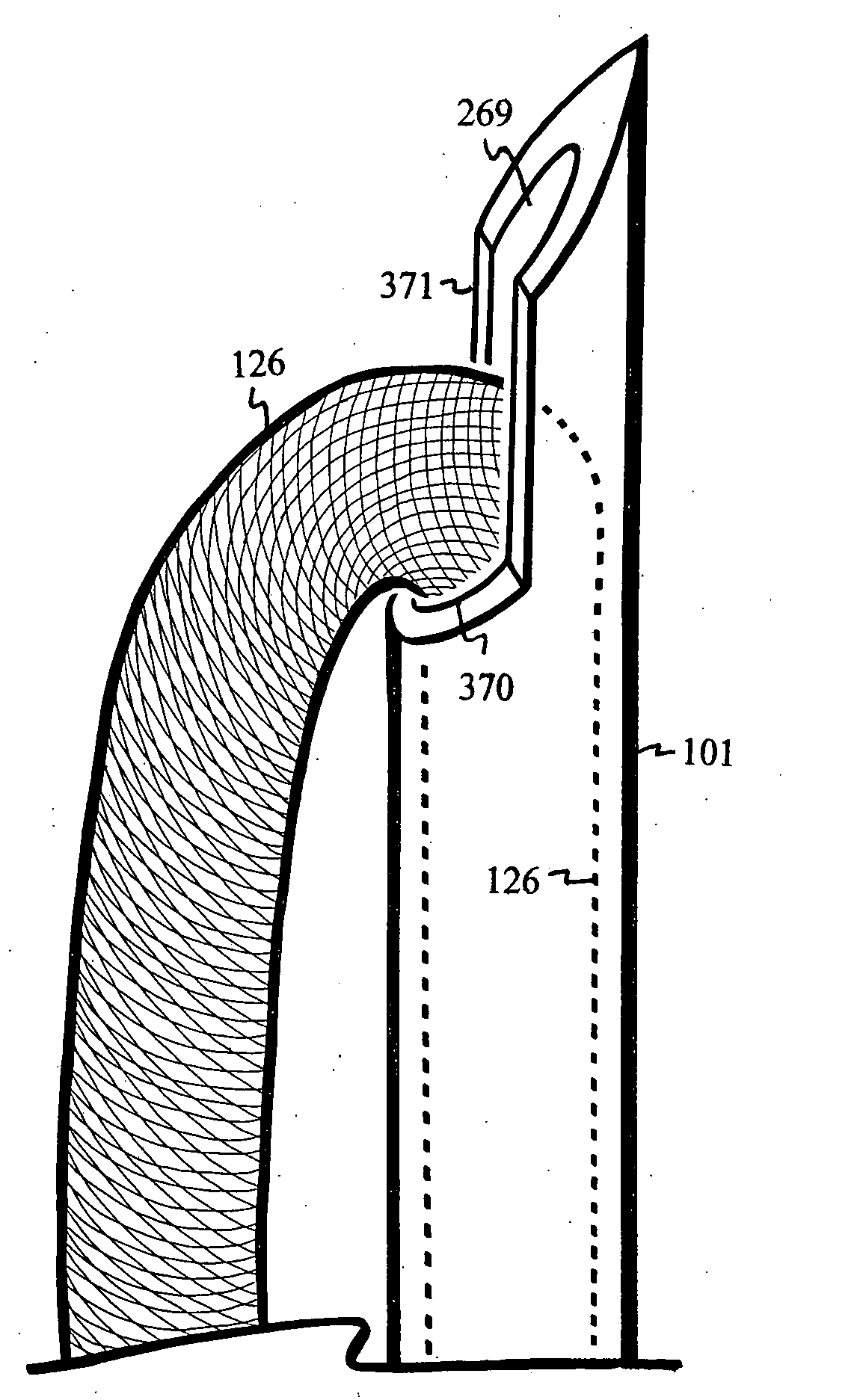 U-shaped disc shunt and delivery device